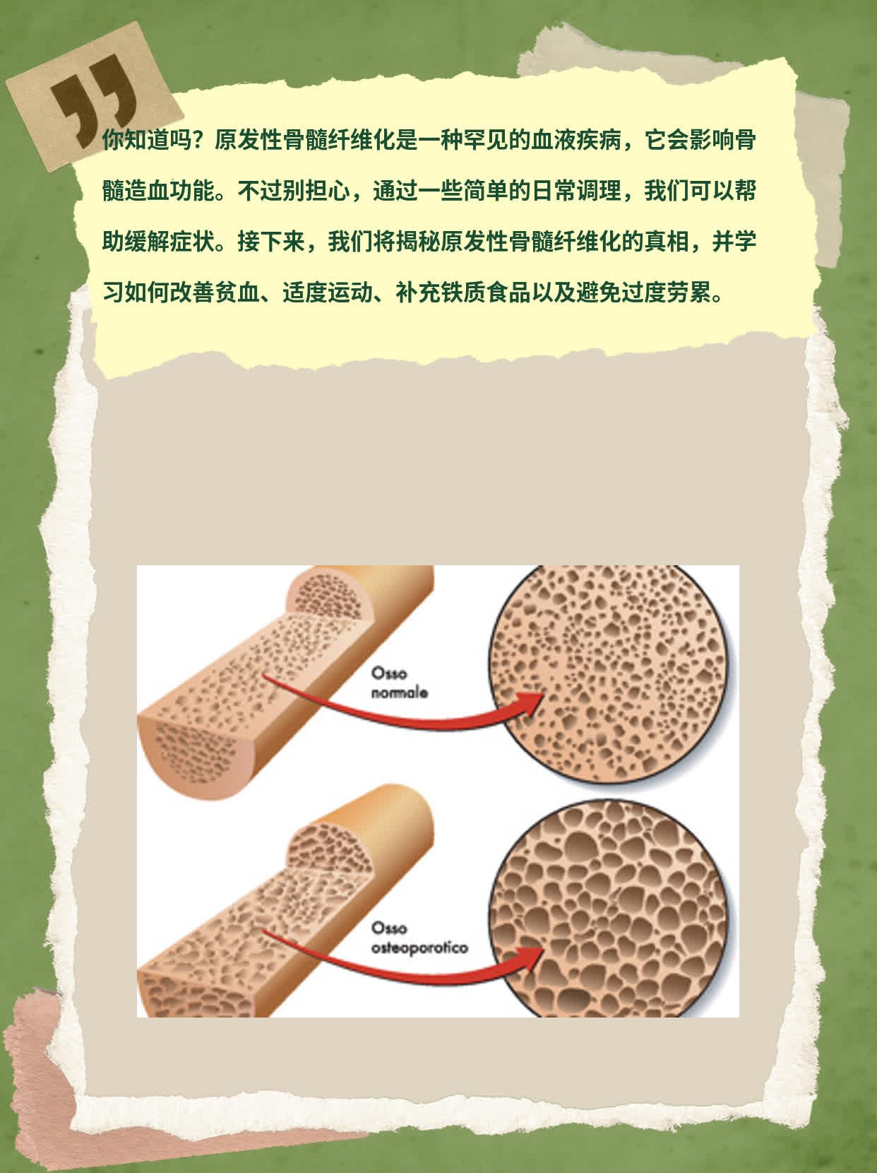 揭秘原发性骨髓纤维化：了解这种疾病的真相！