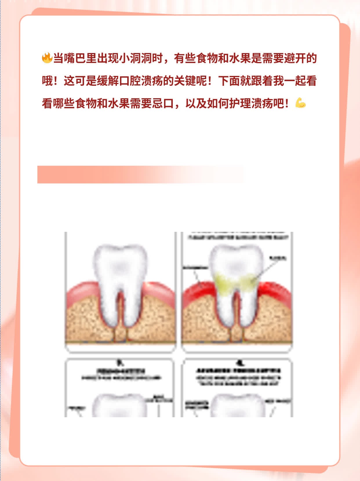 「有口难言」：口腔溃疡时忌食的食物&水果一览表