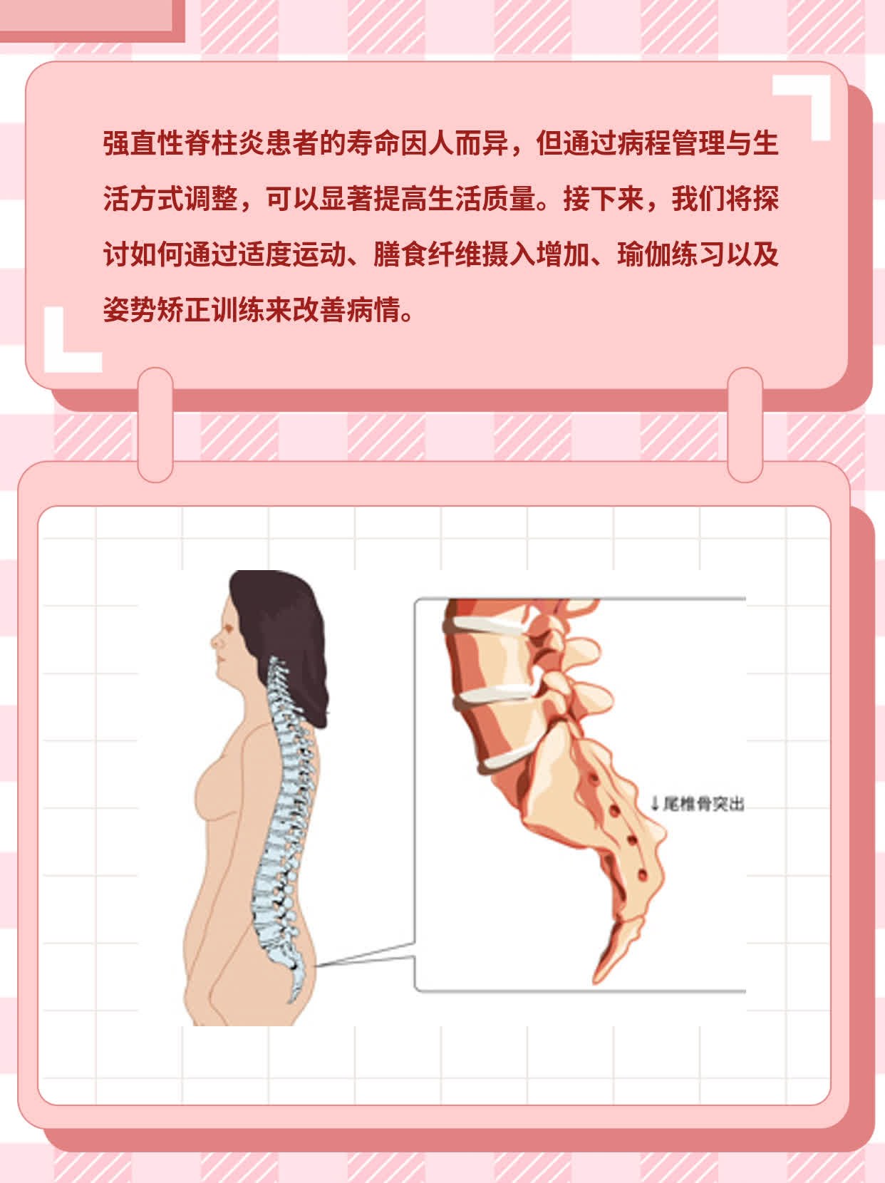 强直性脊柱炎患者的寿命：探索病程管理与生活质量