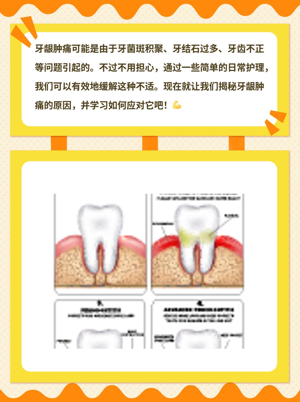 「牙龈肿痛」：揭秘你口腔不适的原因！