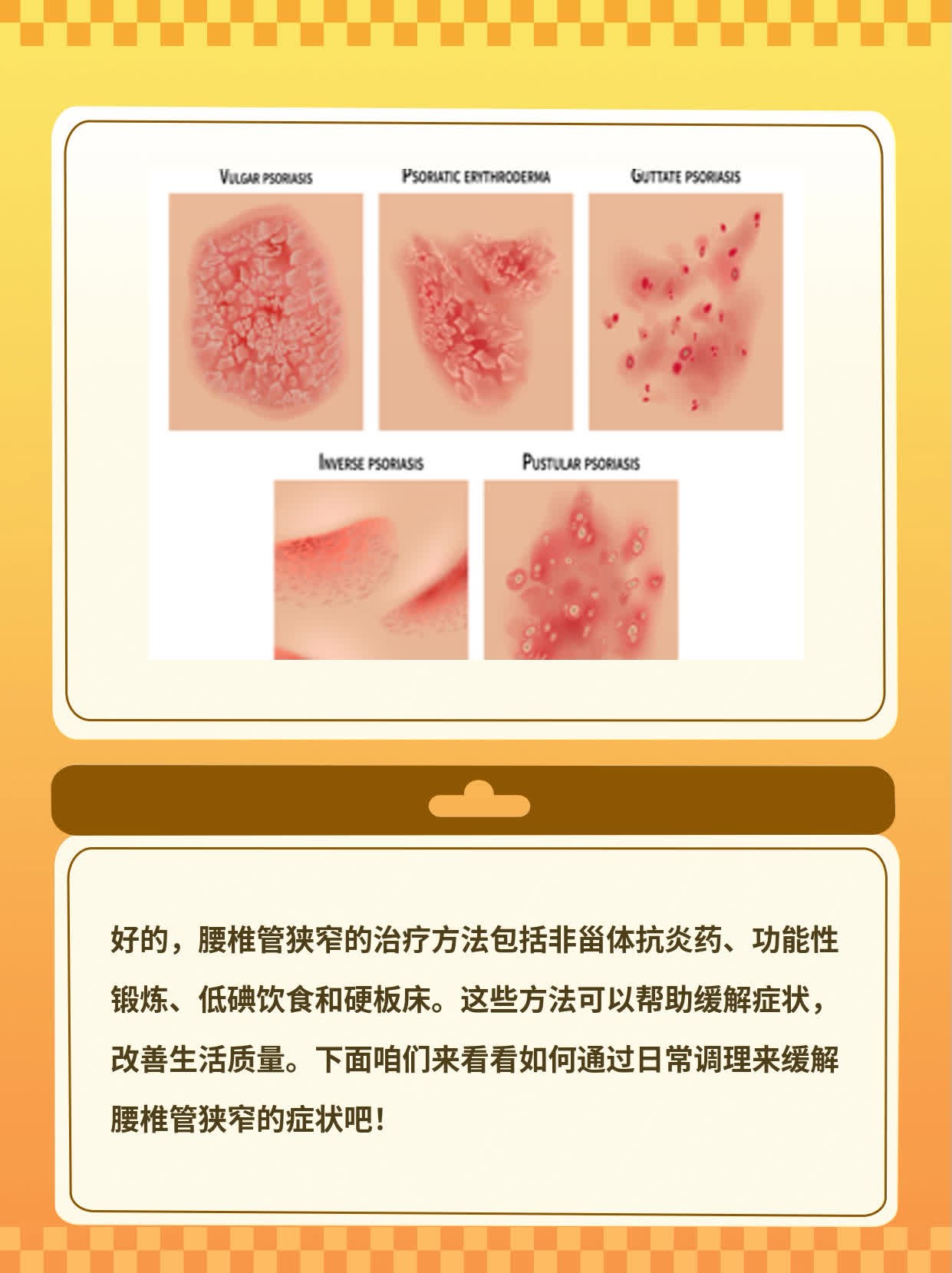 「有图有真相」治疗腰椎管狭窄的方法大全