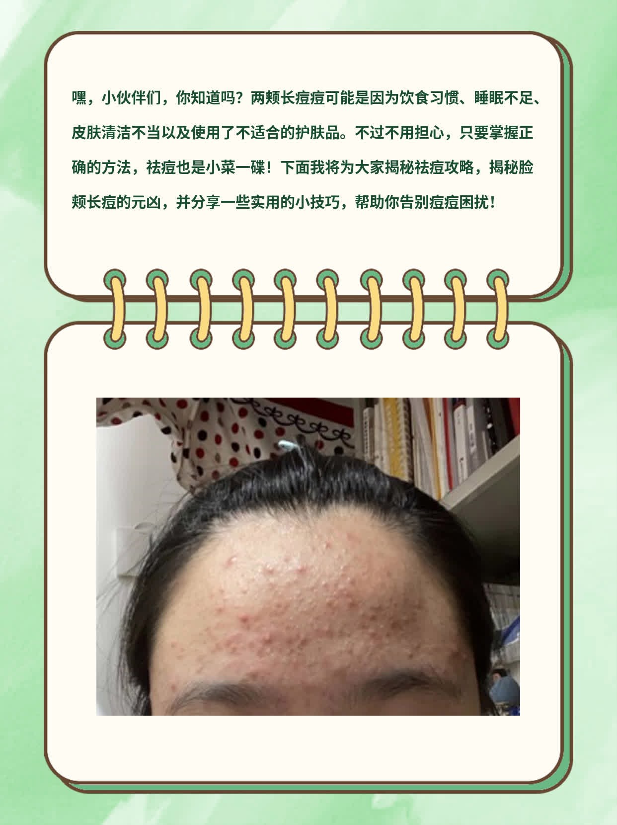 「祛痘攻略」：揭秘脸颊长痘的元凶！