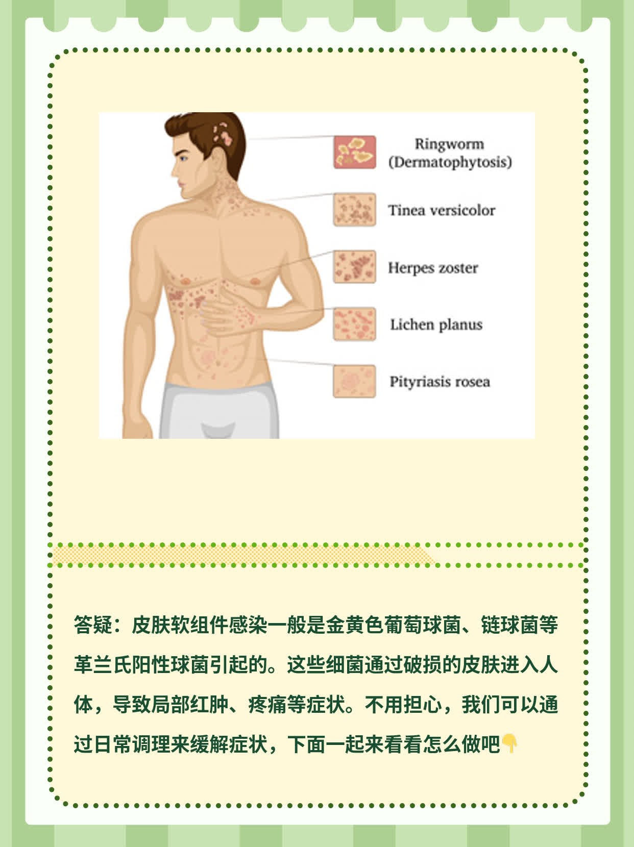 「答疑」皮肤软组件感染是啥菌？