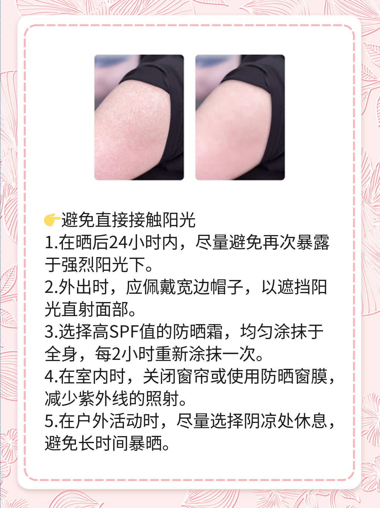「夏日必备」晒后急救：快速缓解红肿！