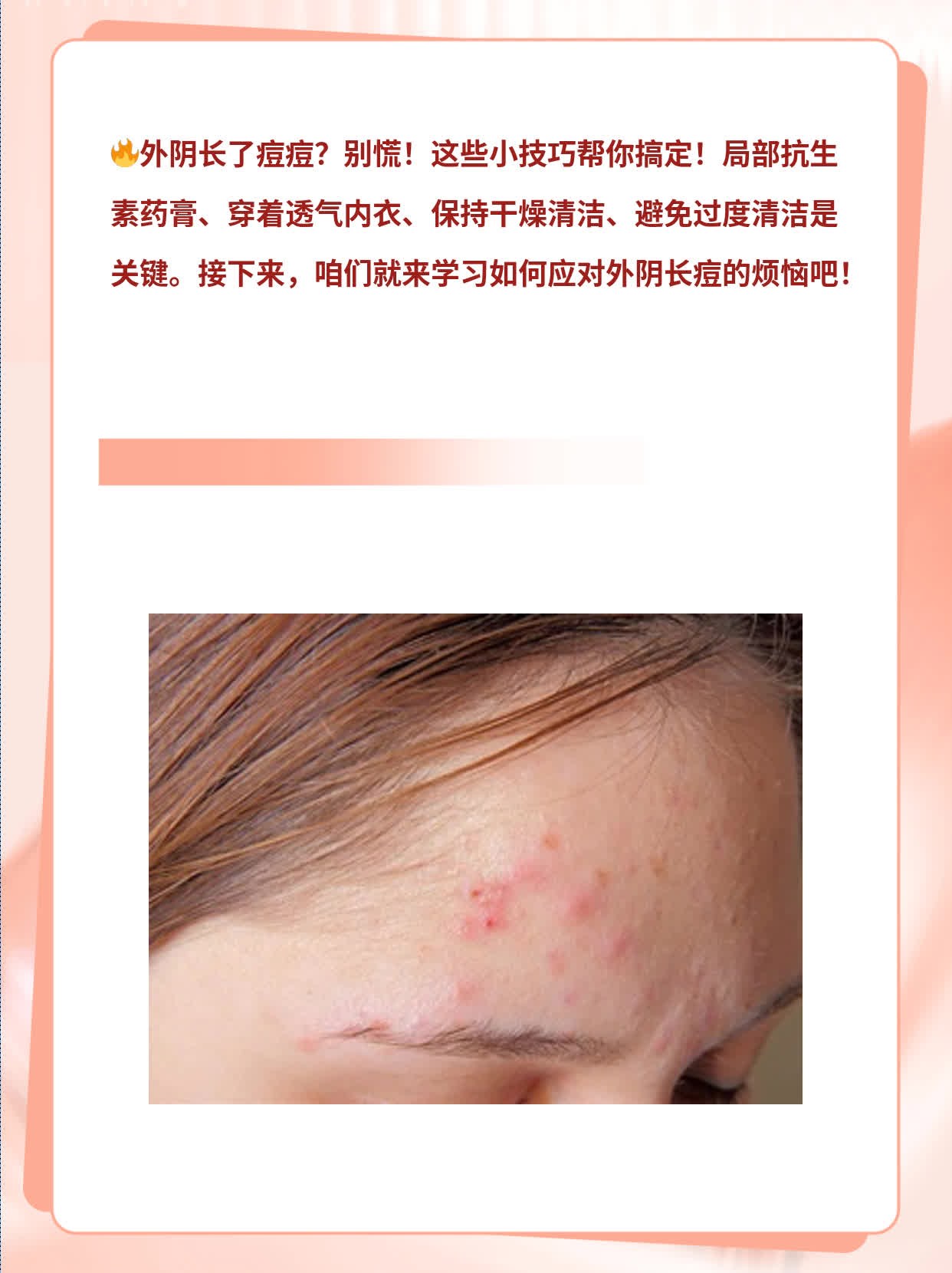 「外阴长痘」：小疙瘩也有“小心机”！