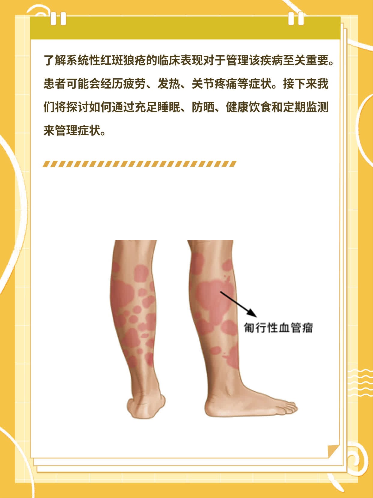 「经验分享」系统性红斑狼疮的临床表现一览表