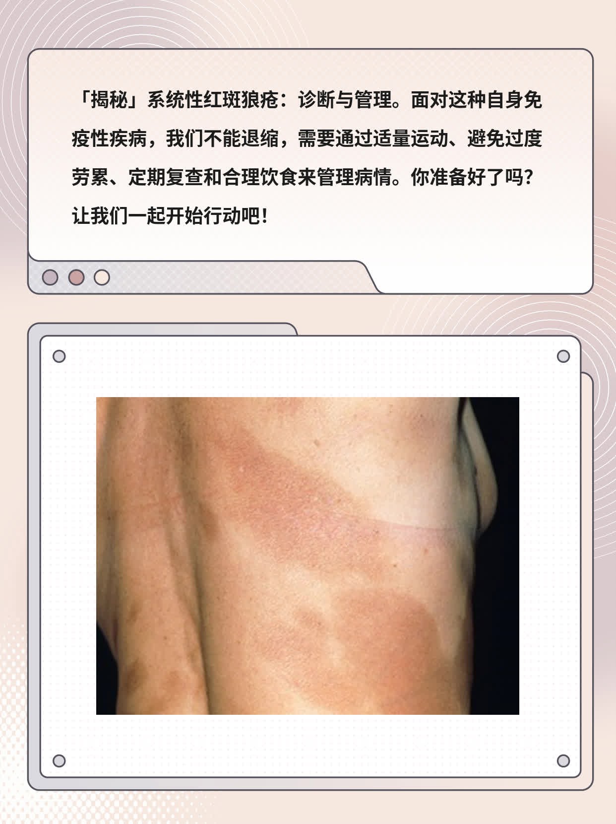 「揭秘」系统性红斑狼疮：诊断与管理