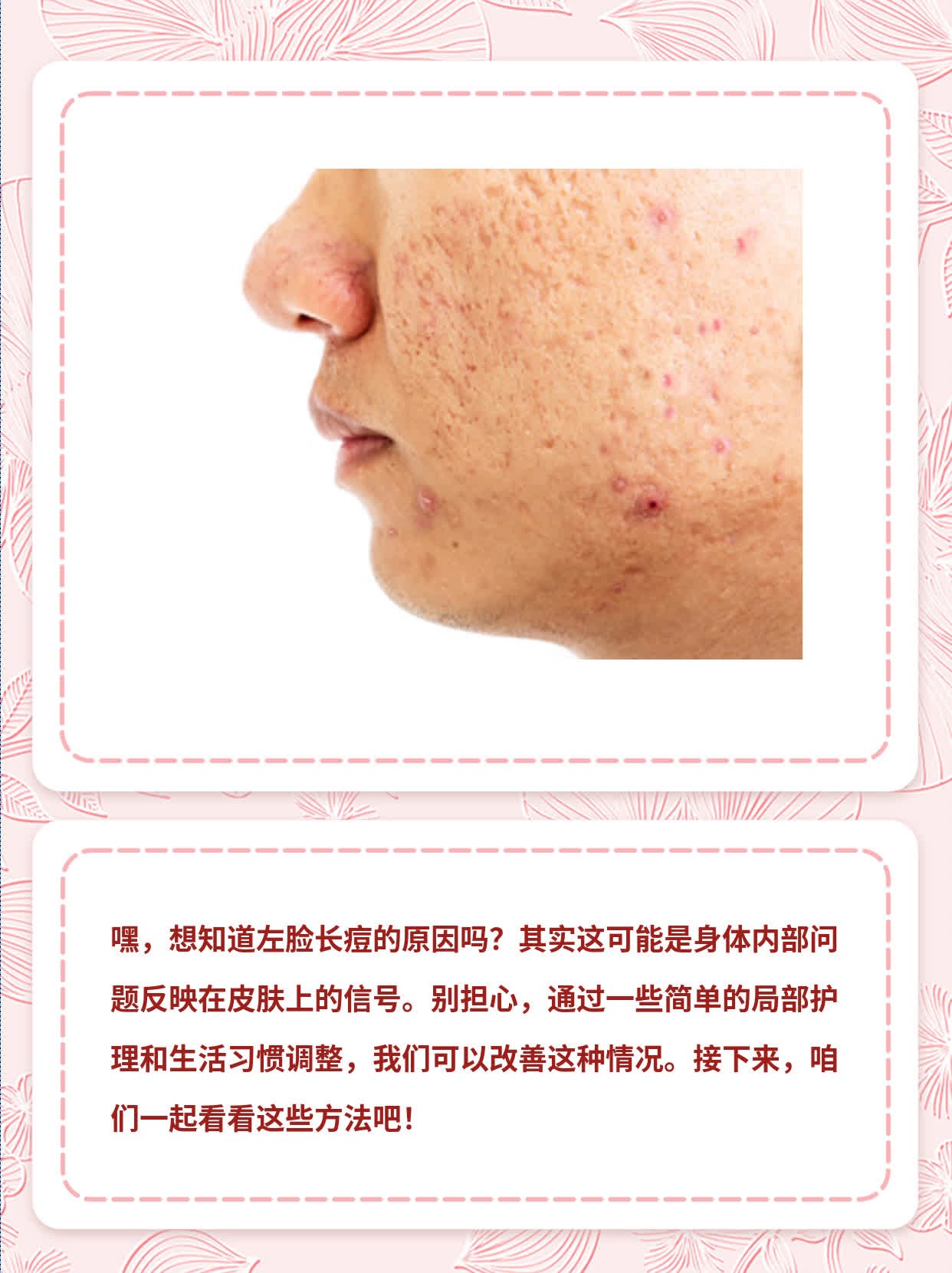右脸长痘？揭秘左侧粉刺成因！
