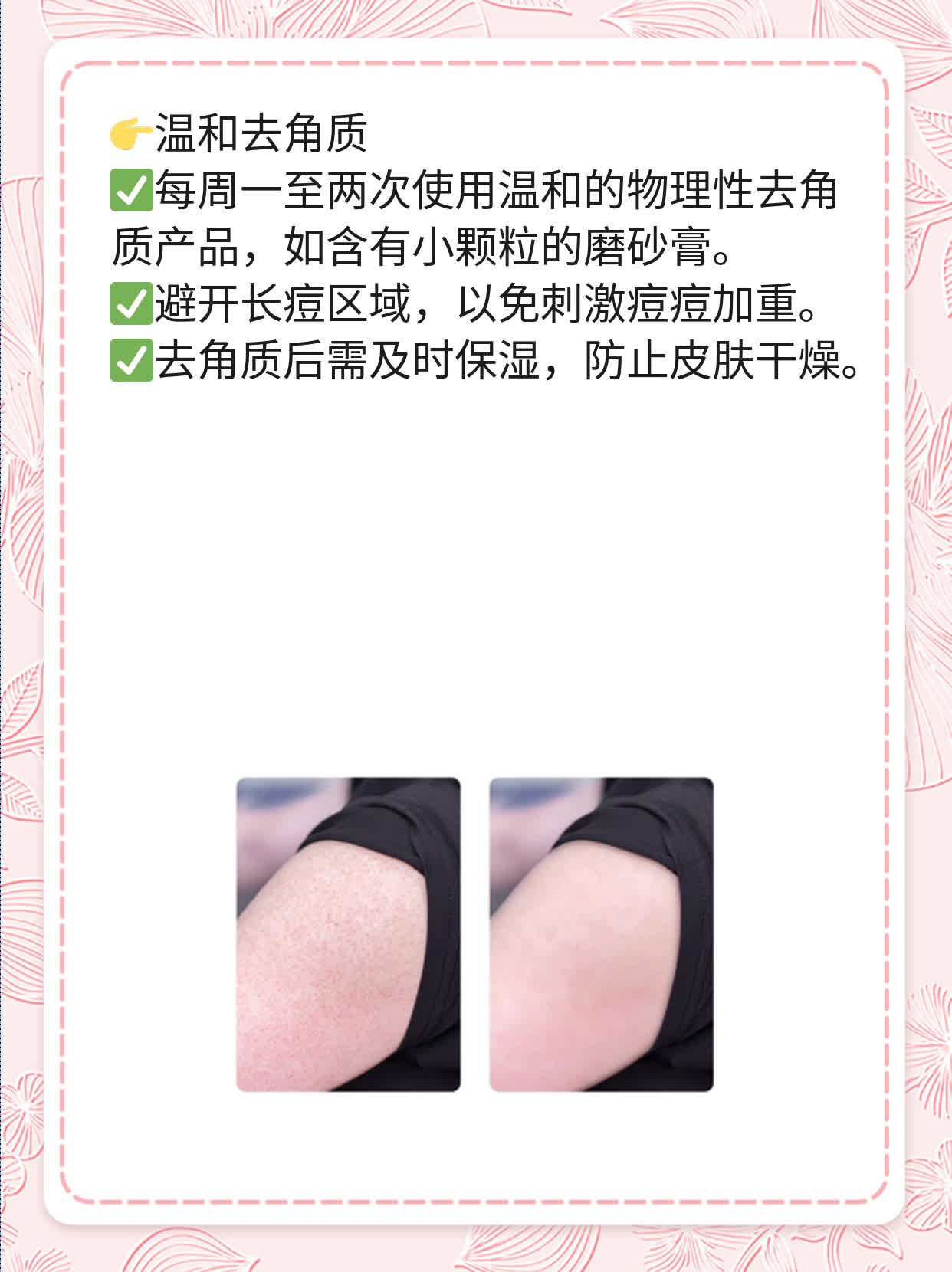 右脸长痘？揭秘左侧粉刺成因！