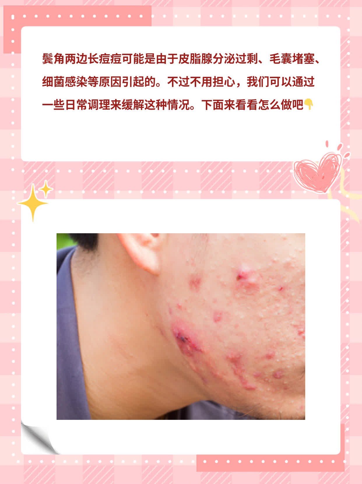 鬓边小痘痘？揭秘背后的原因！