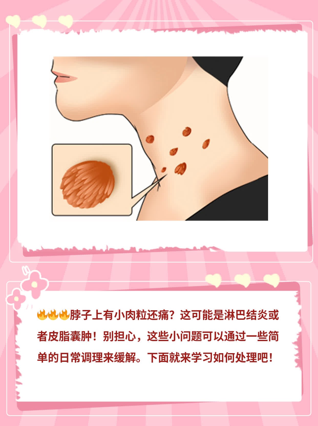 「脖子上有小肉粒还痛」？这可能是……