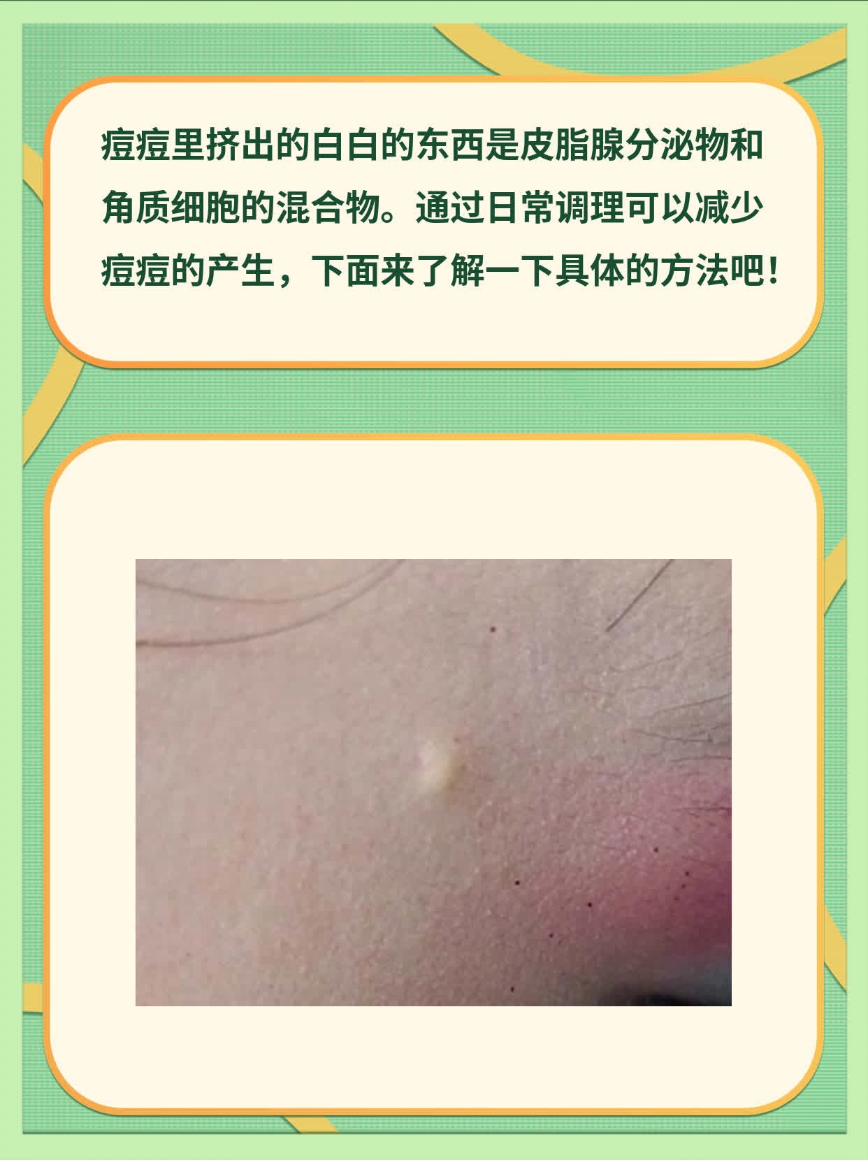揭秘：痘痘里挤出的白白的东西竟是……！
