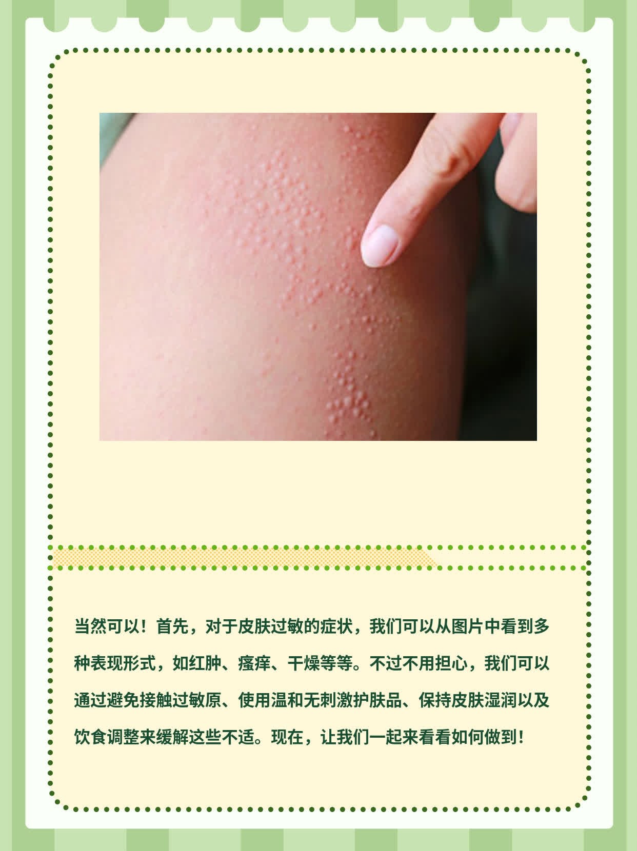 揭秘不同皮肤过敏症状及图片展示！