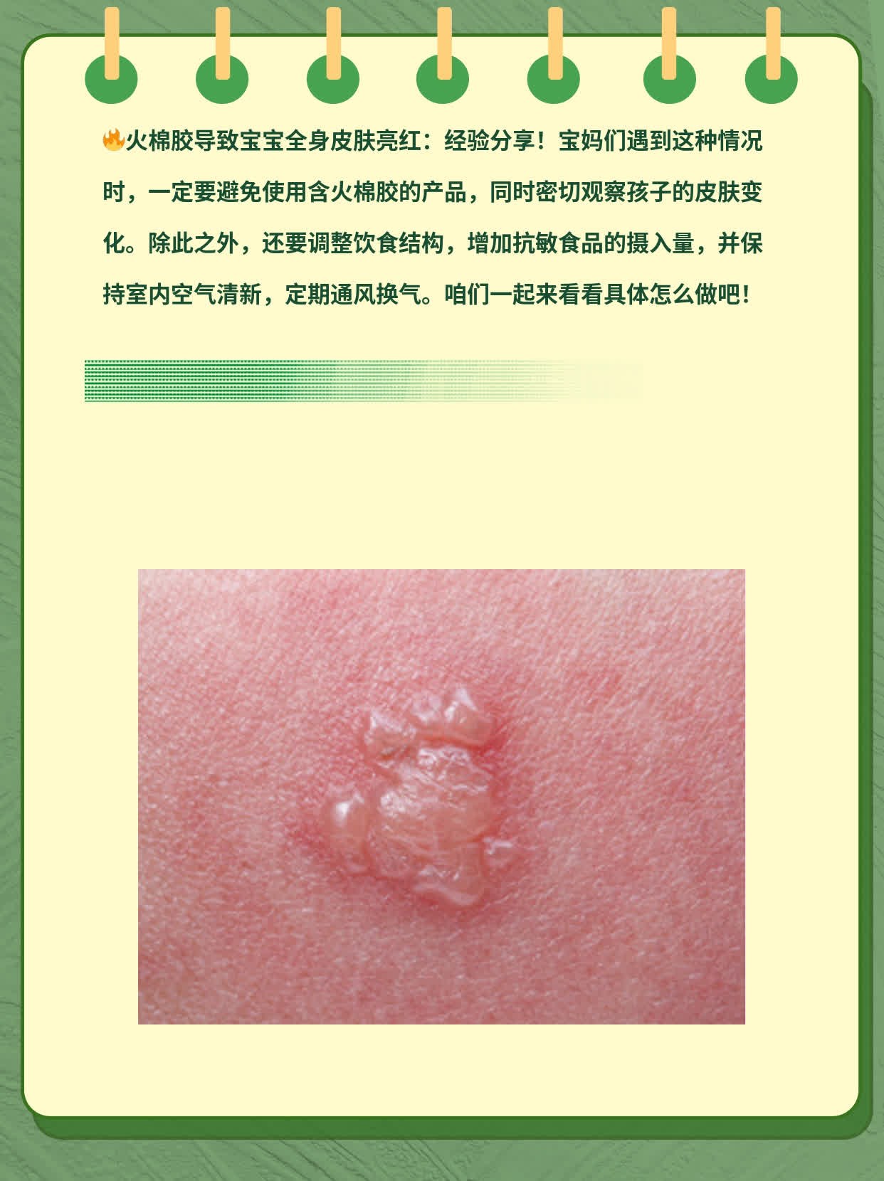 火棉胶导致宝宝全身皮肤亮红：经验分享