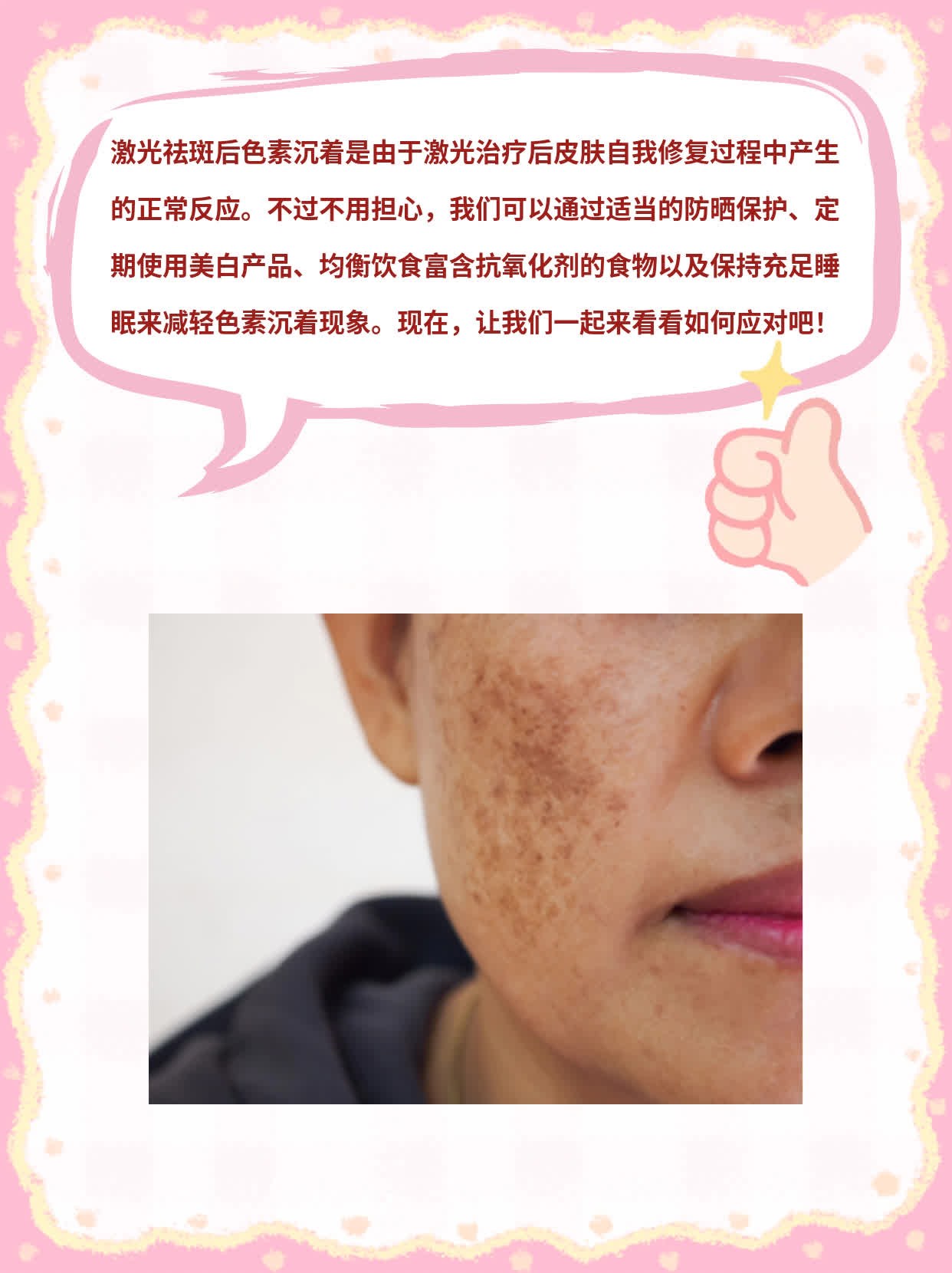 揭秘激光祛斑后的色素沉着现象！