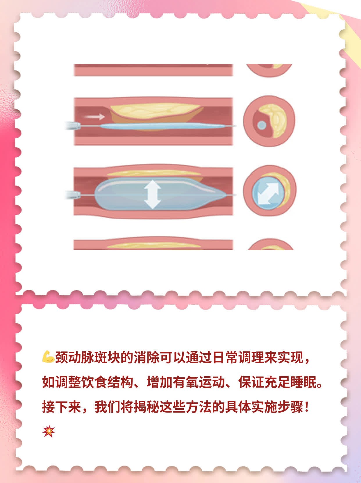 「消除颈动脉斑块」的经验分享：治疗策略揭秘！