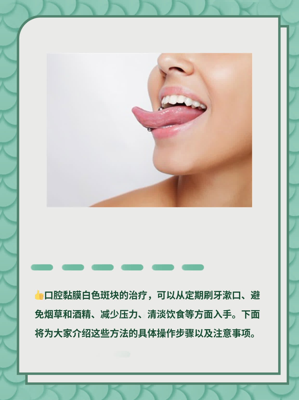 「经验分享」治疗口腔白斑的有效方法
