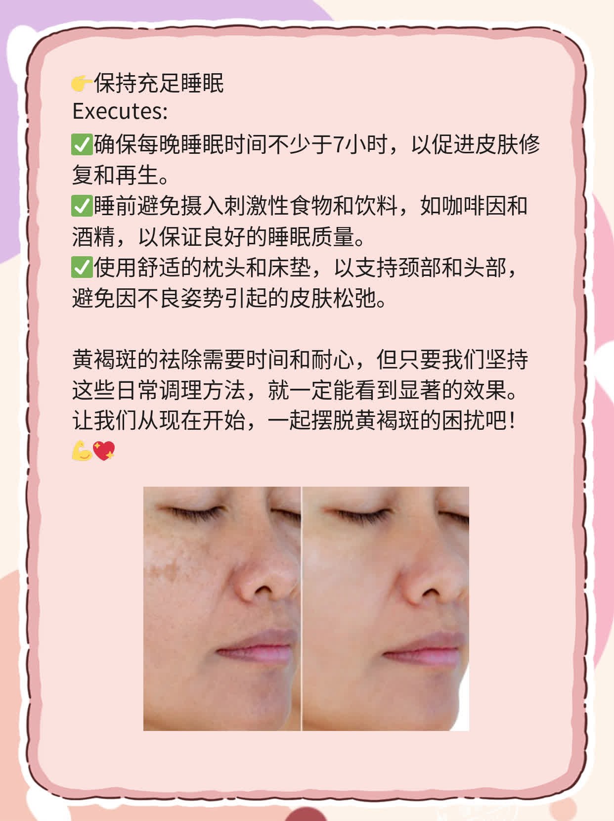 「祛除黄褐斑」：经验分享
