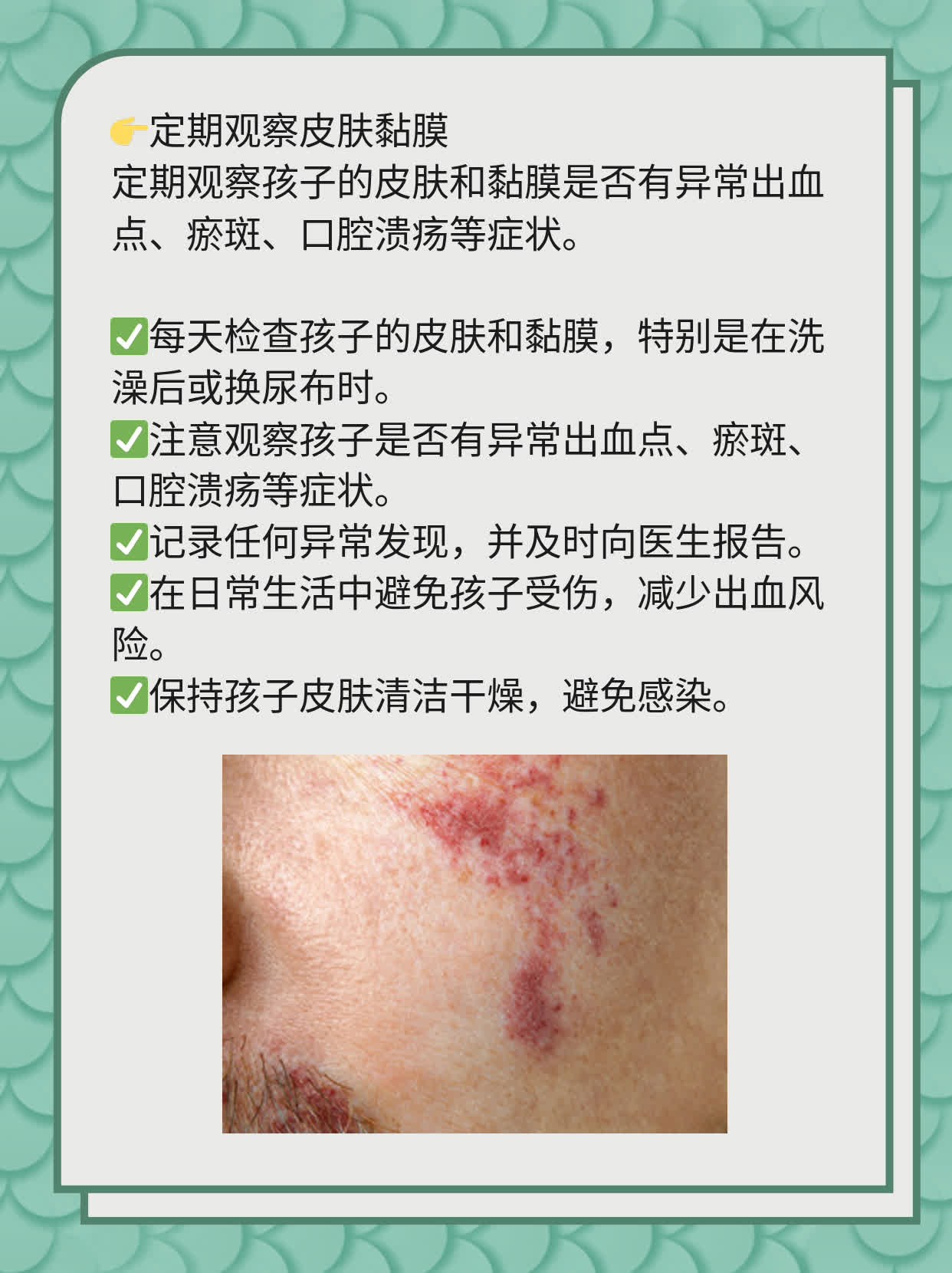 「经验分享」幼儿白血病：早期症状&前兆识别
