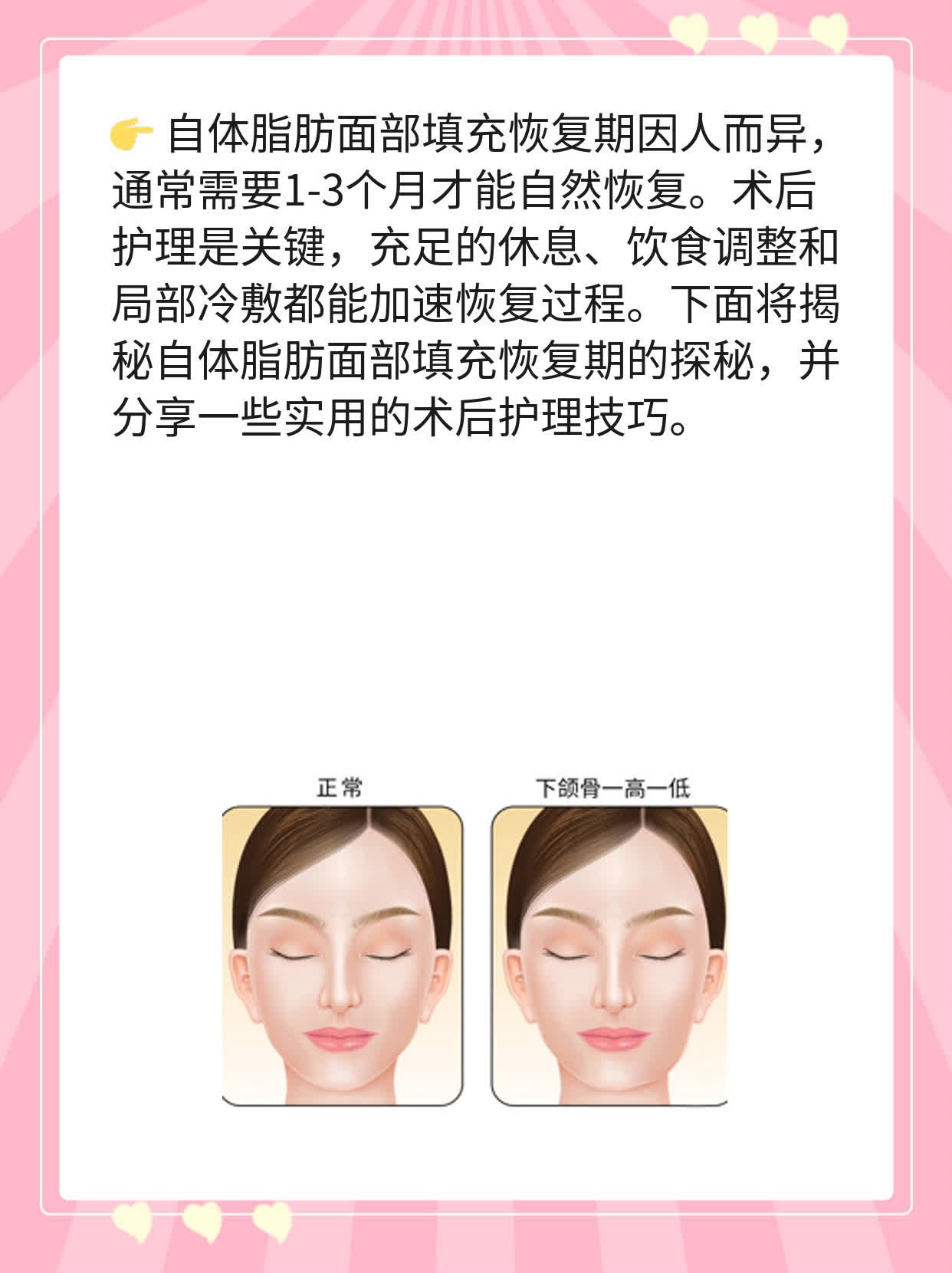 自体脂肪面部填充恢复期探秘