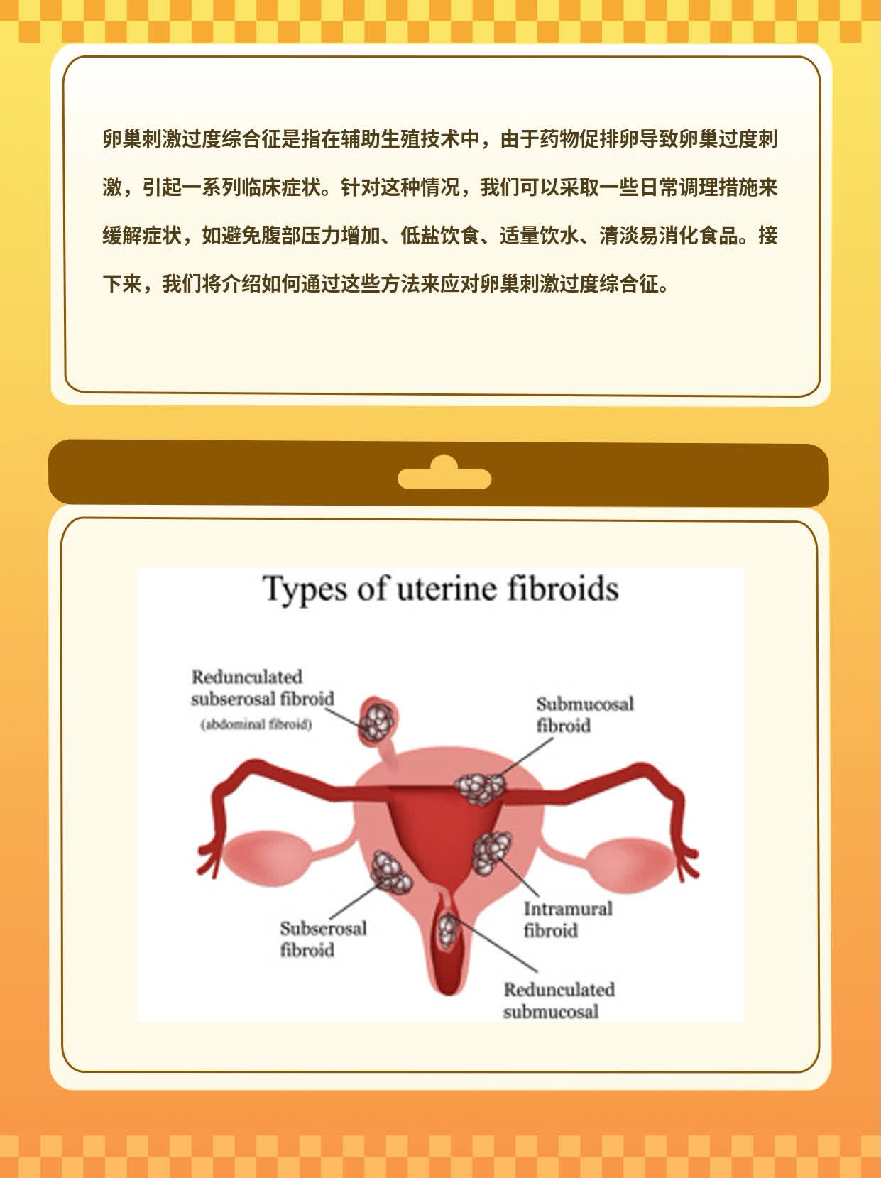 卵巢刺激过度综合征探秘：如何应对？