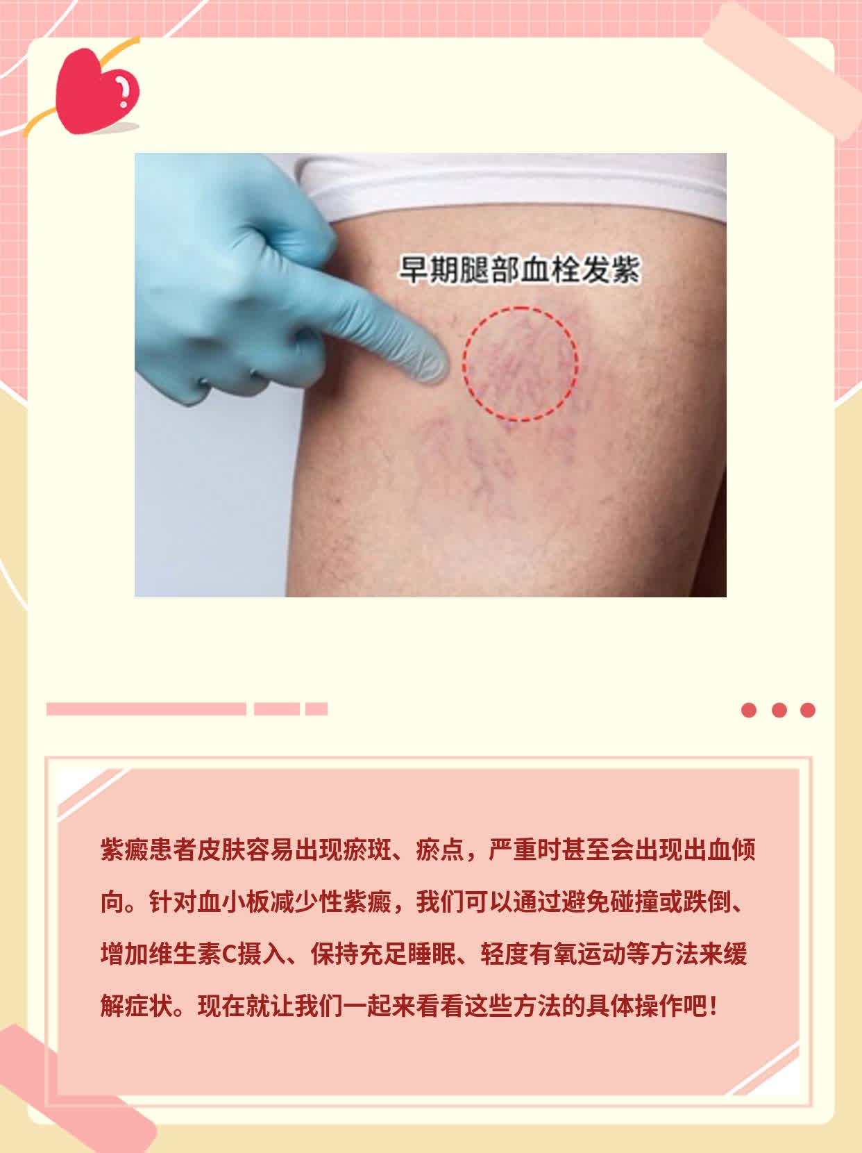 探秘紫癜背后的故事：血小板减少性紫癜的症状解析