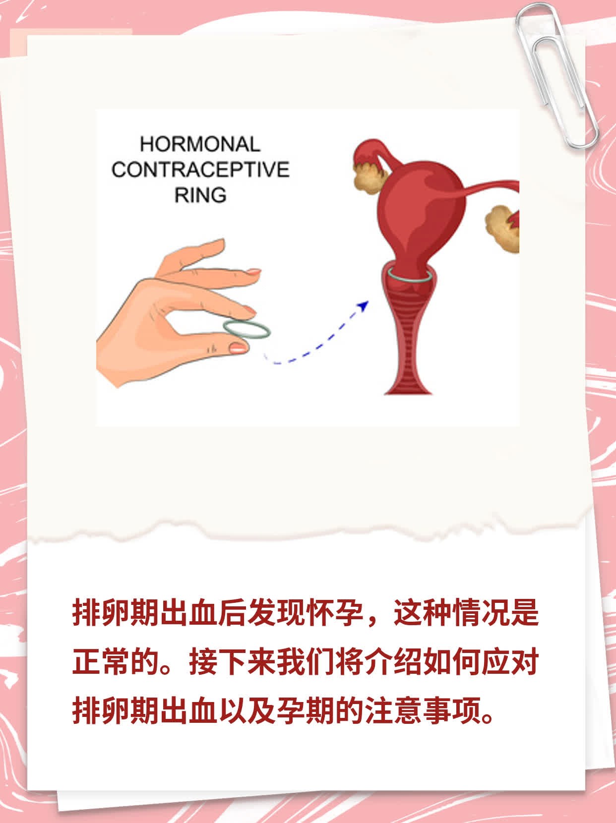 排卵期出血后发现怀孕，靠谱吗？
