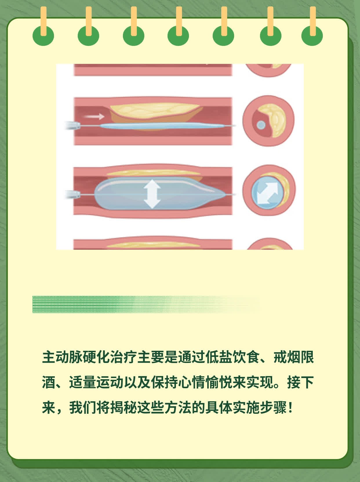 「经验分享」主动脉硬化治疗全攻略：多种方法大揭秘！