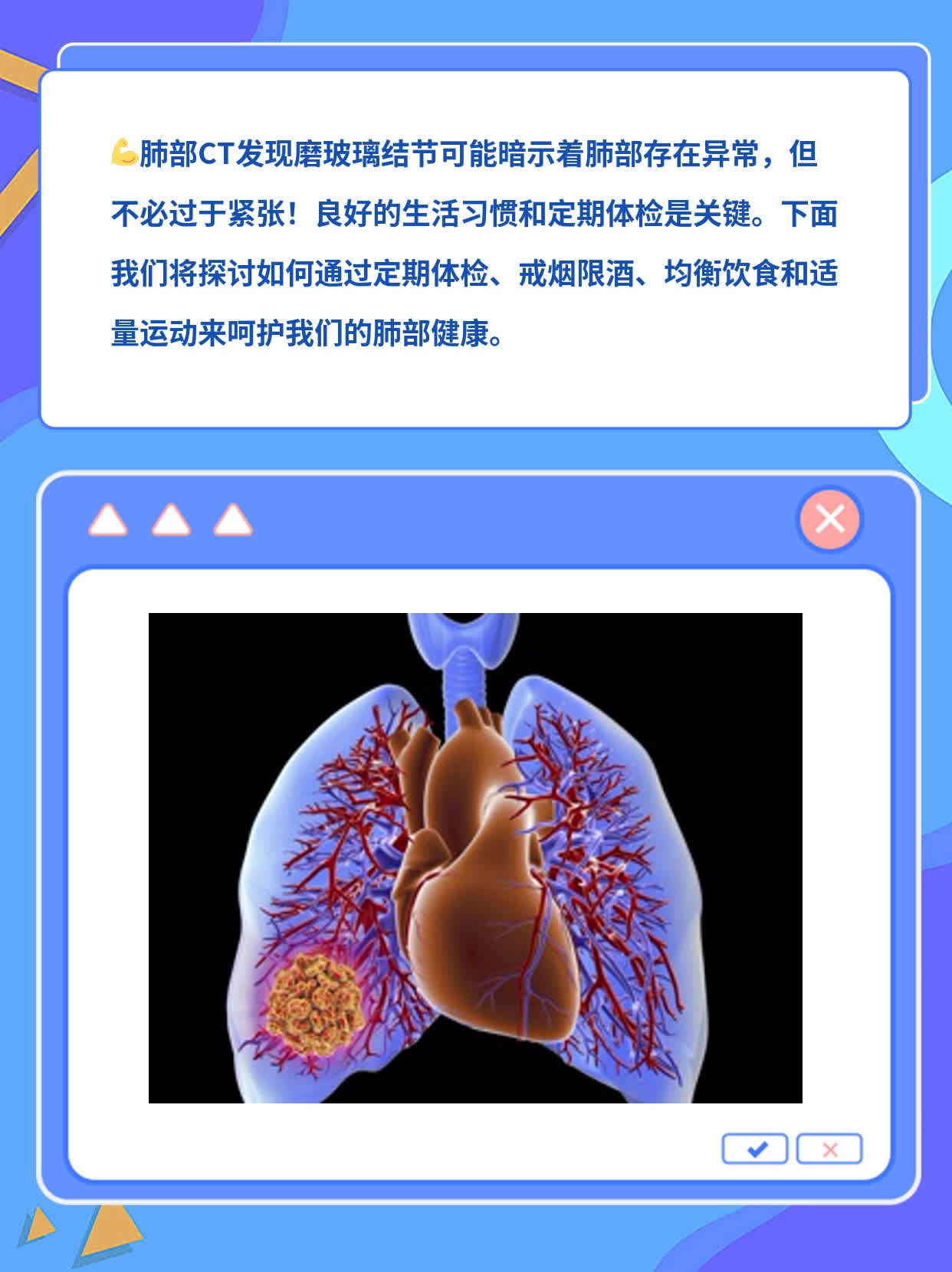 磨玻璃结节：肺部CT中的小问题大关注！