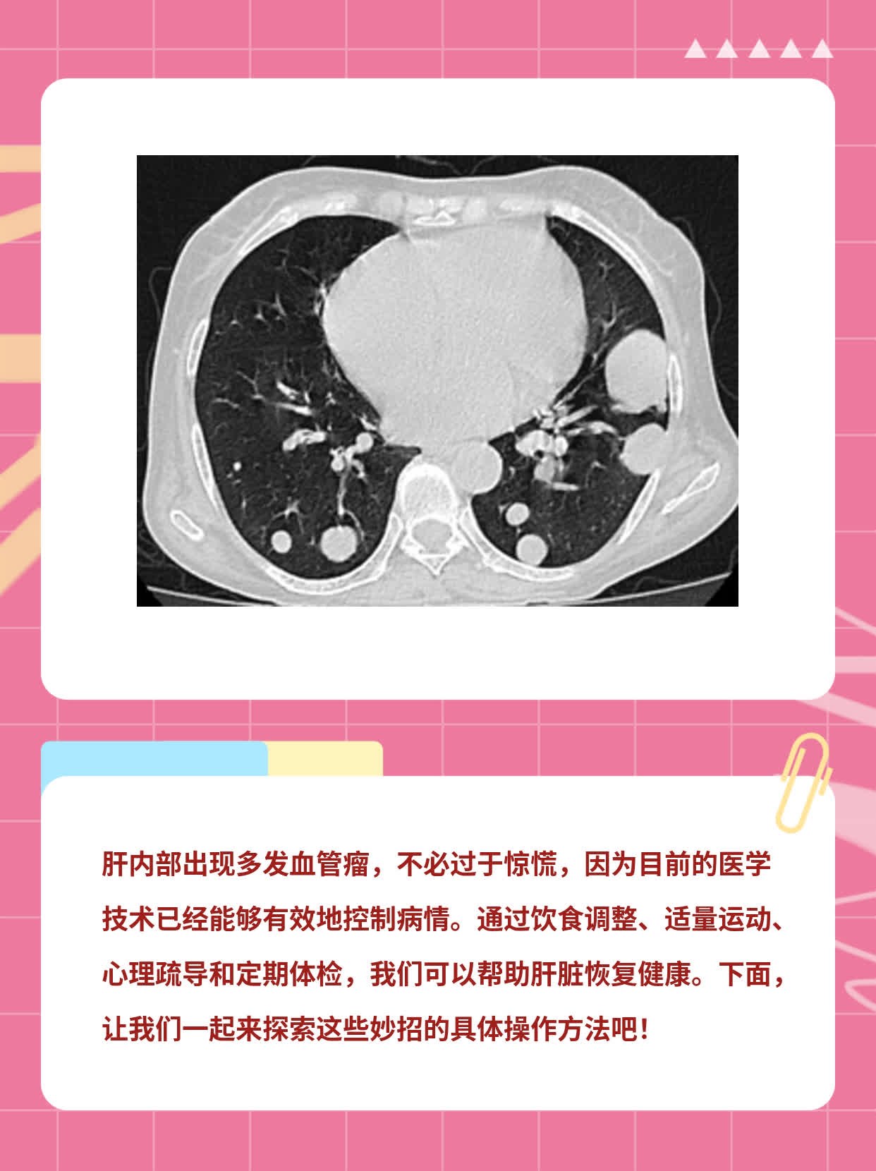 「经验分享」肝内多发血管瘤的治疗妙法探秘