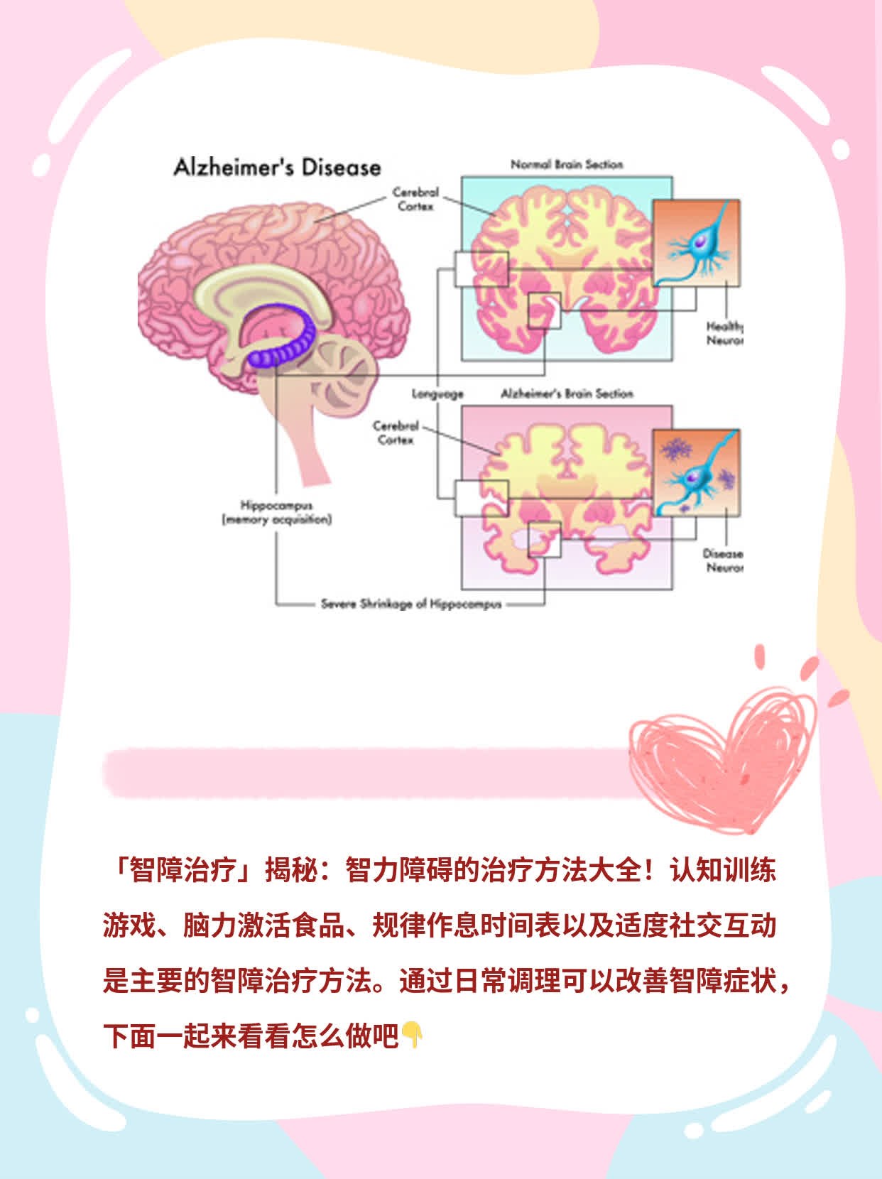 「智障治疗」揭秘：智力障碍的治疗方法大全！