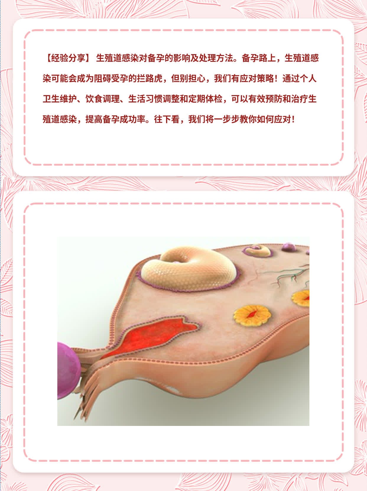 【经验分享】 生殖道感染对备孕的影响及处理方法