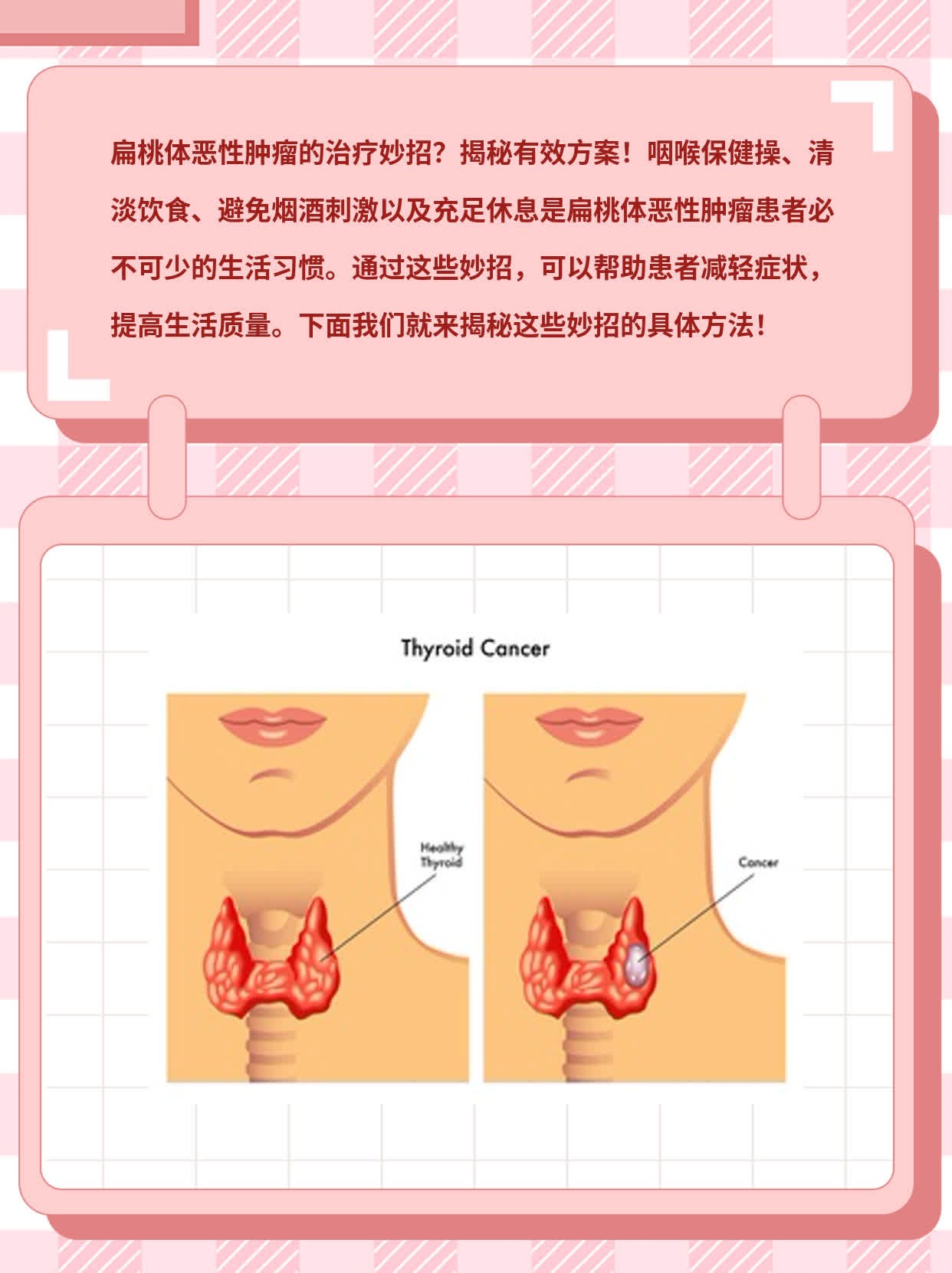 扁桃体恶性肿瘤治疗妙招：揭秘有效方案！