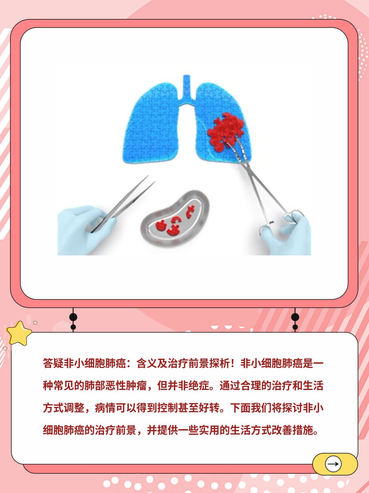 「答疑」非小细胞肺癌：含义及治疗前景探析