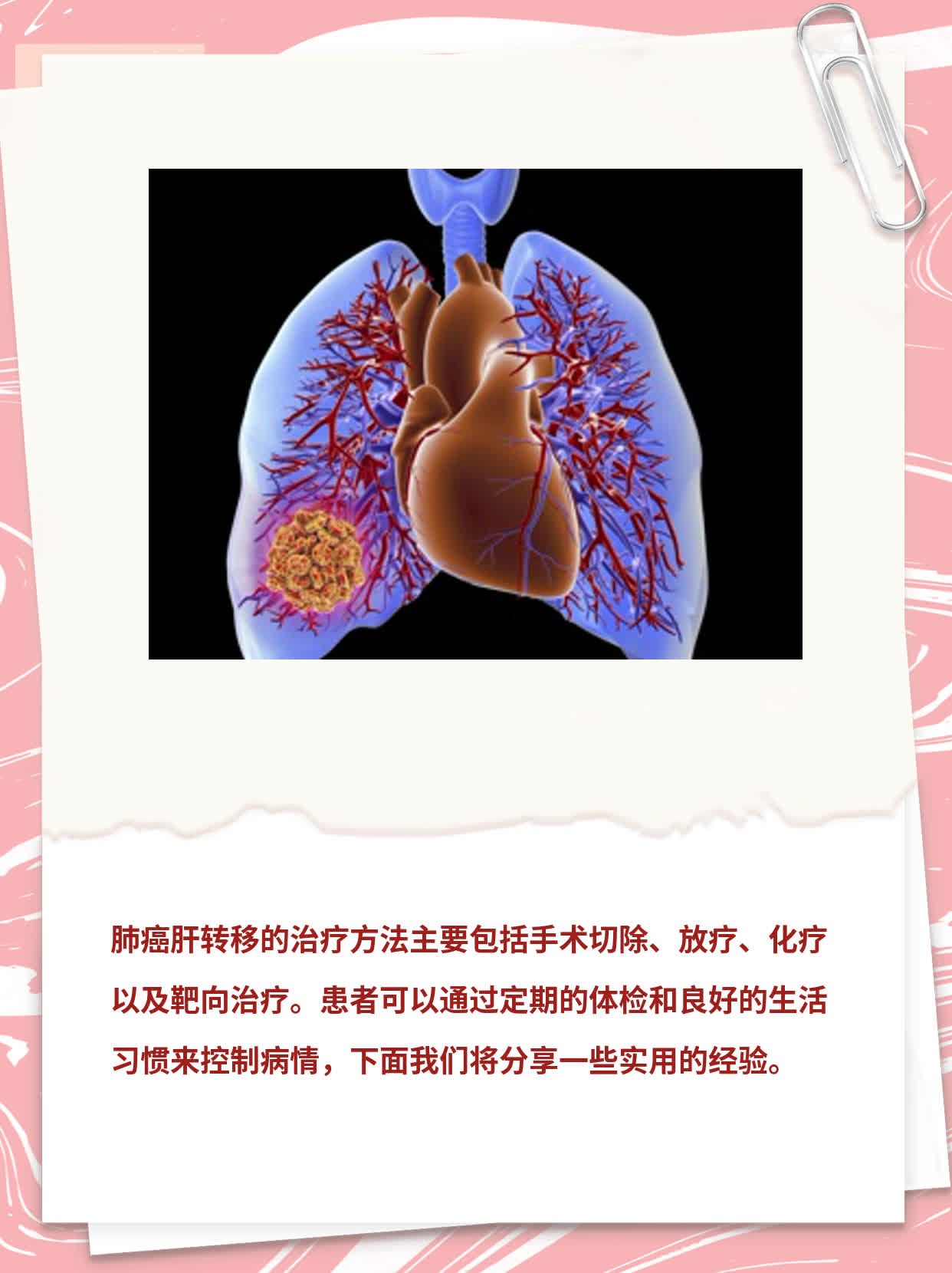 「肺癌肝转」经验分享：治疗方案大揭秘！