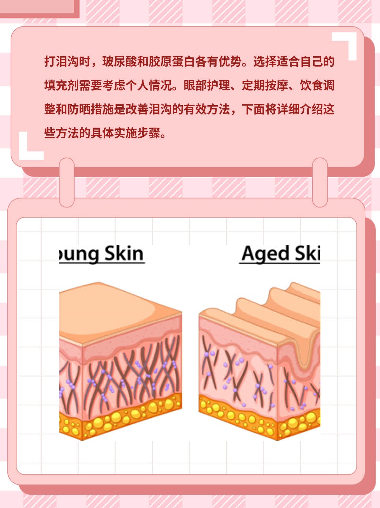 泪沟填充：玻尿酸 vs 胶原蛋白，哪种更胜一筹？