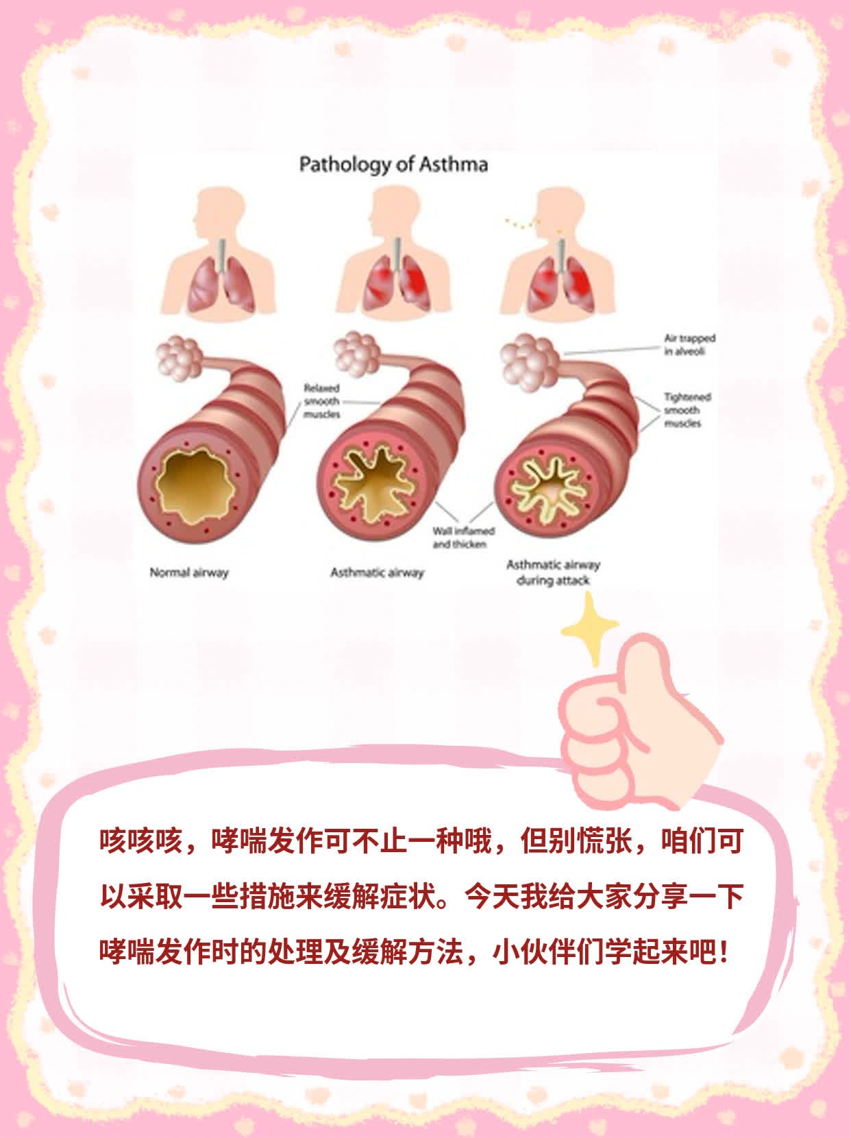 「哮喘发作」：发作时的处理及缓解方法分享！