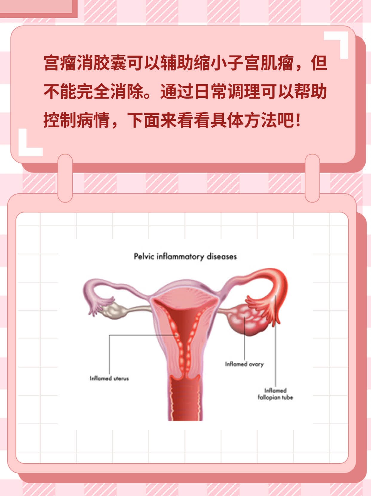 宫瘤消胶囊有效缩小子宫肌瘤