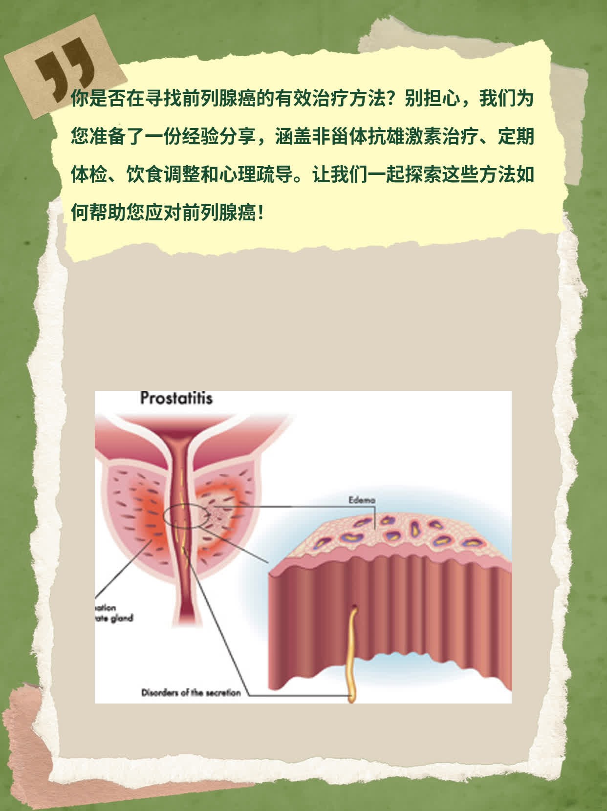 「前列腺癌治疗」经验分享：探索有效方法！