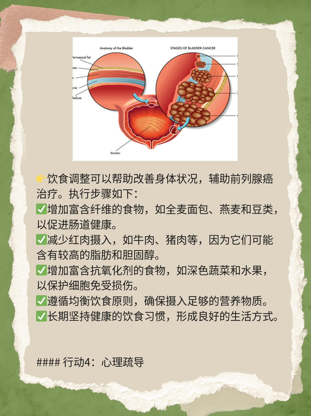 「前列腺癌治疗」经验分享：探索有效方法！