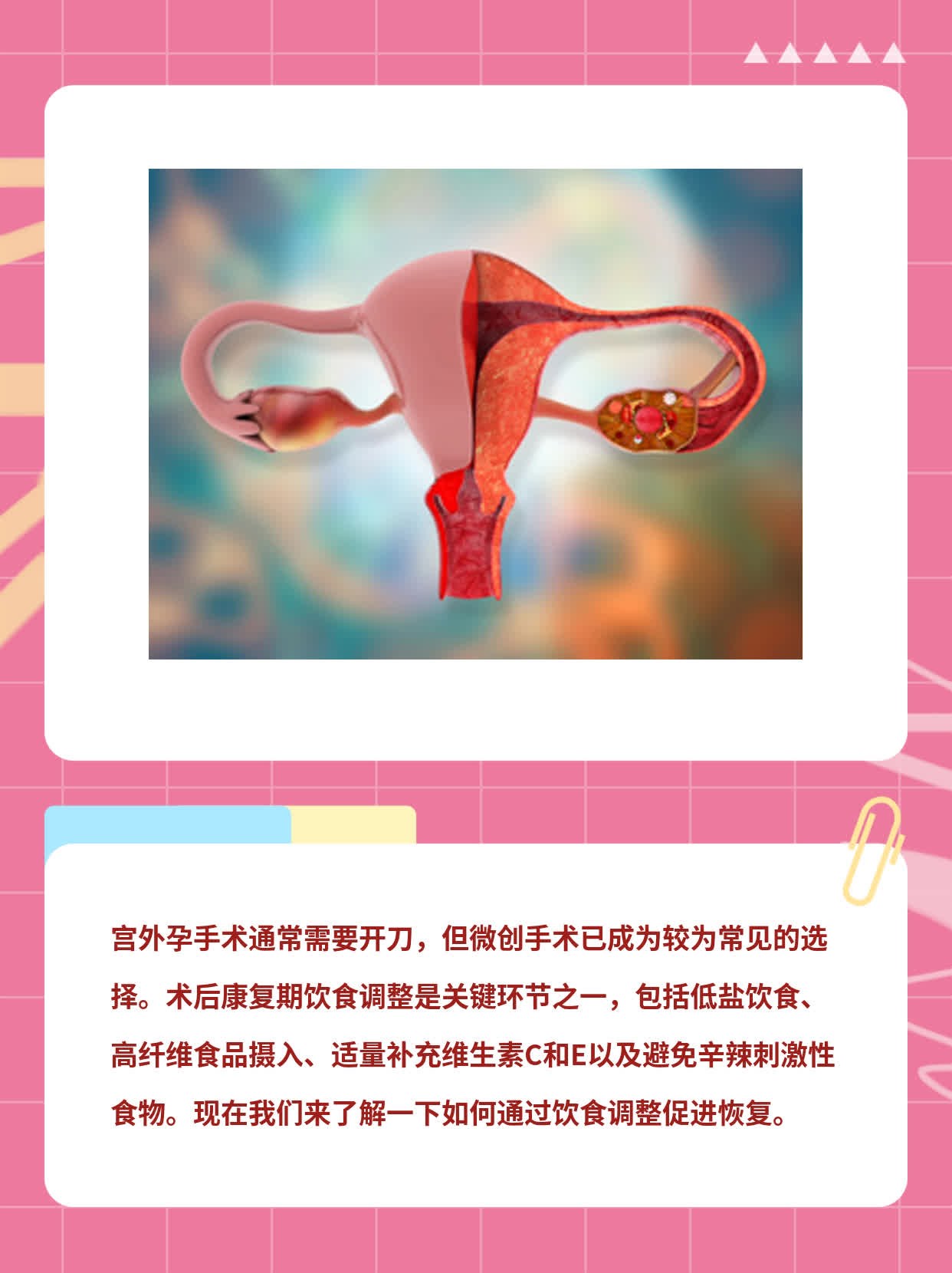 宫外孕手术方式及是否需开刀解析