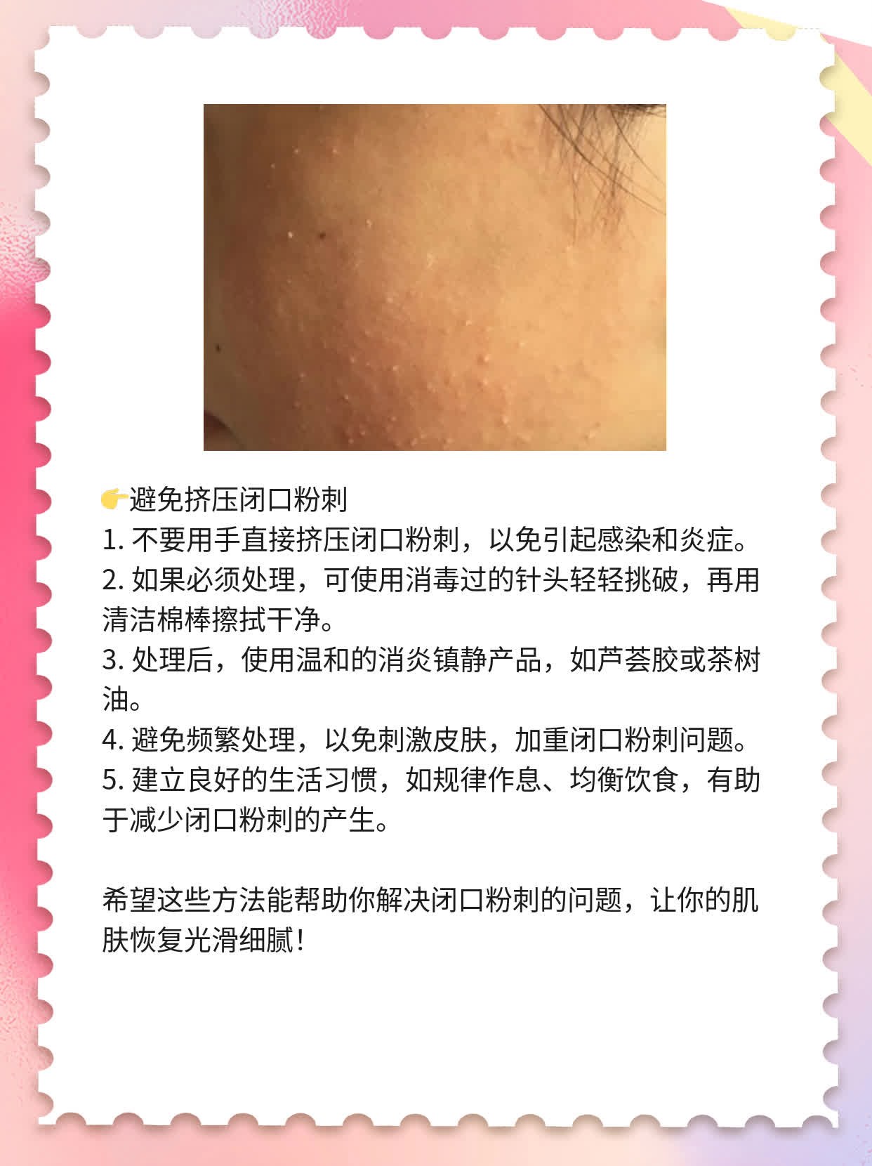 破解闭口粉刺烦恼：祛除脸上小疙瘩的方法大全！