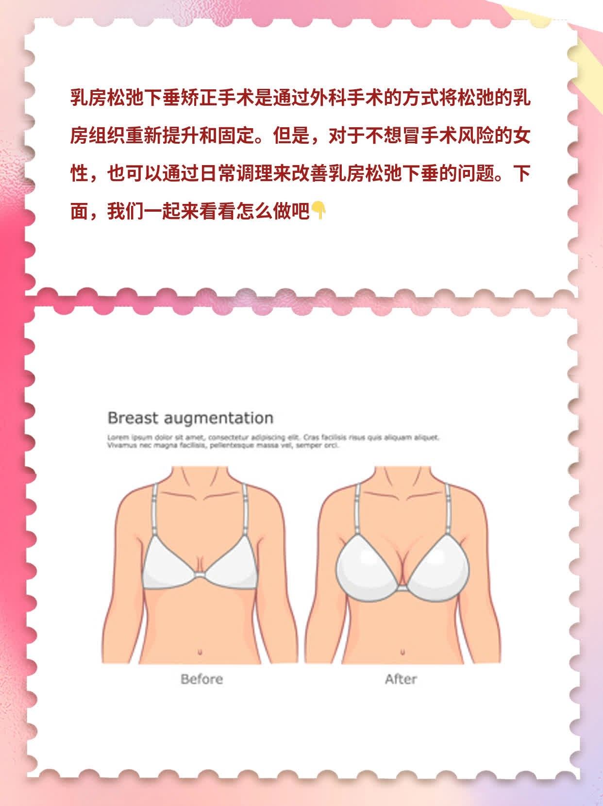 揭秘：乳房松弛下垂矫正术全攻略！
