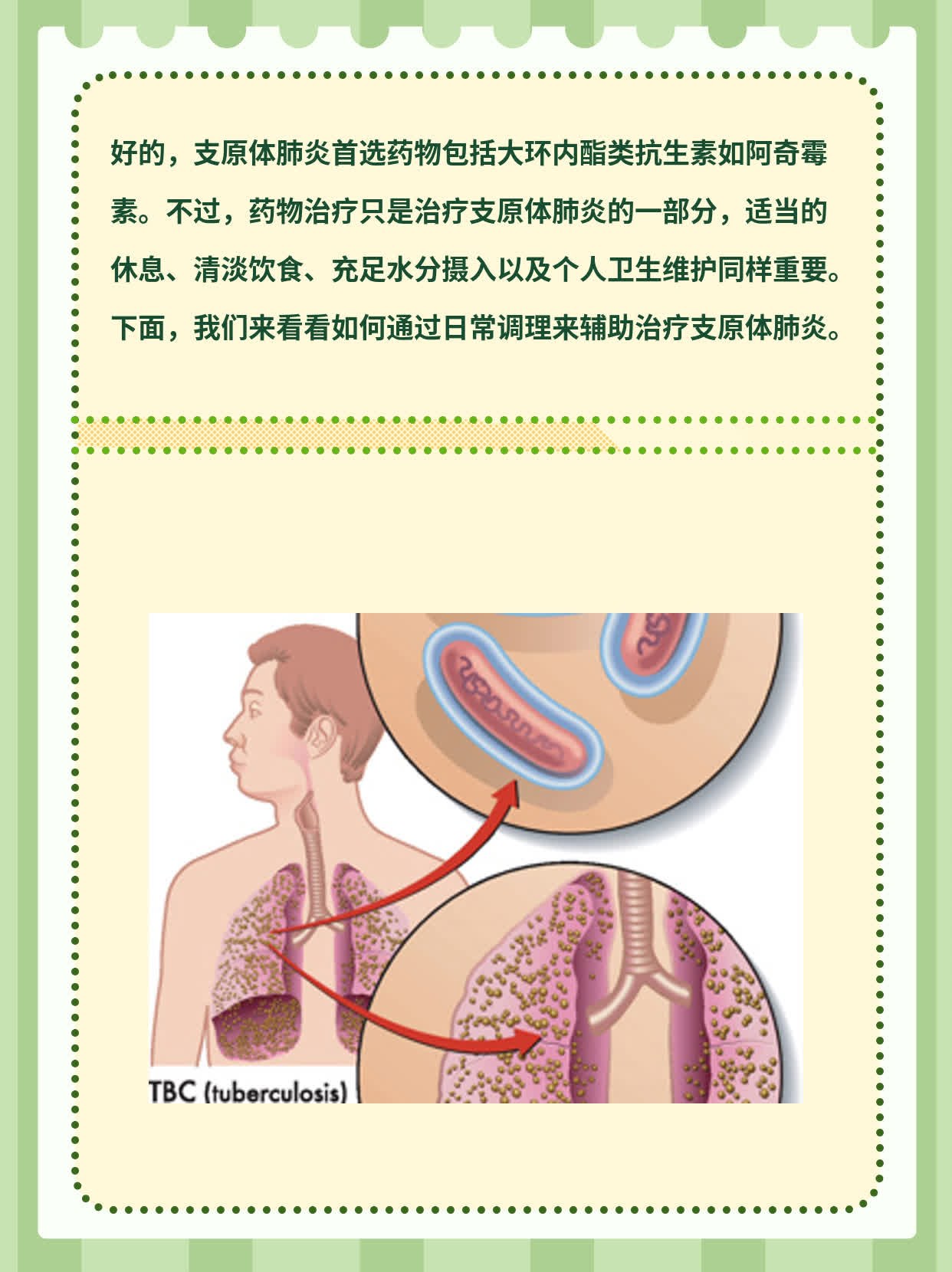 支原体肺炎首选药物分享