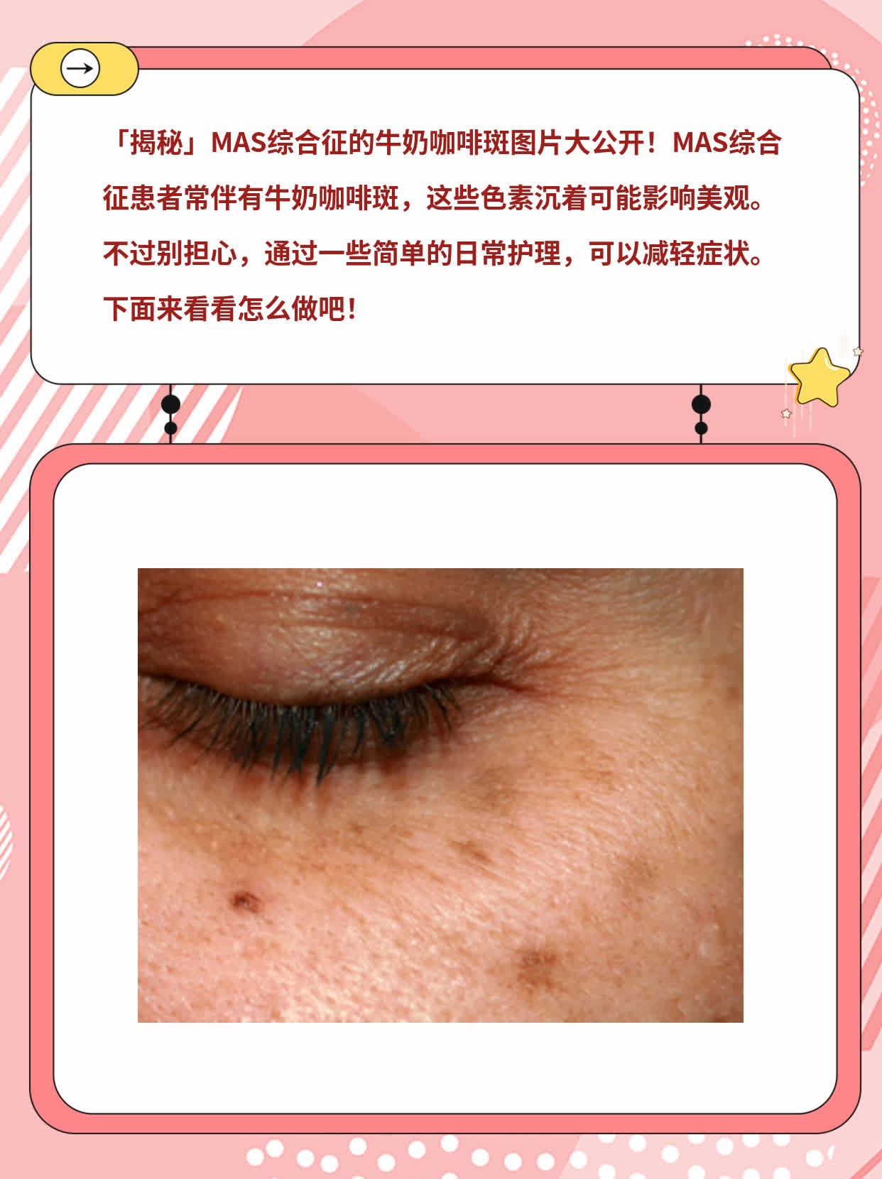 「揭秘」MAS综合征的牛奶咖啡斑图片大公开！
