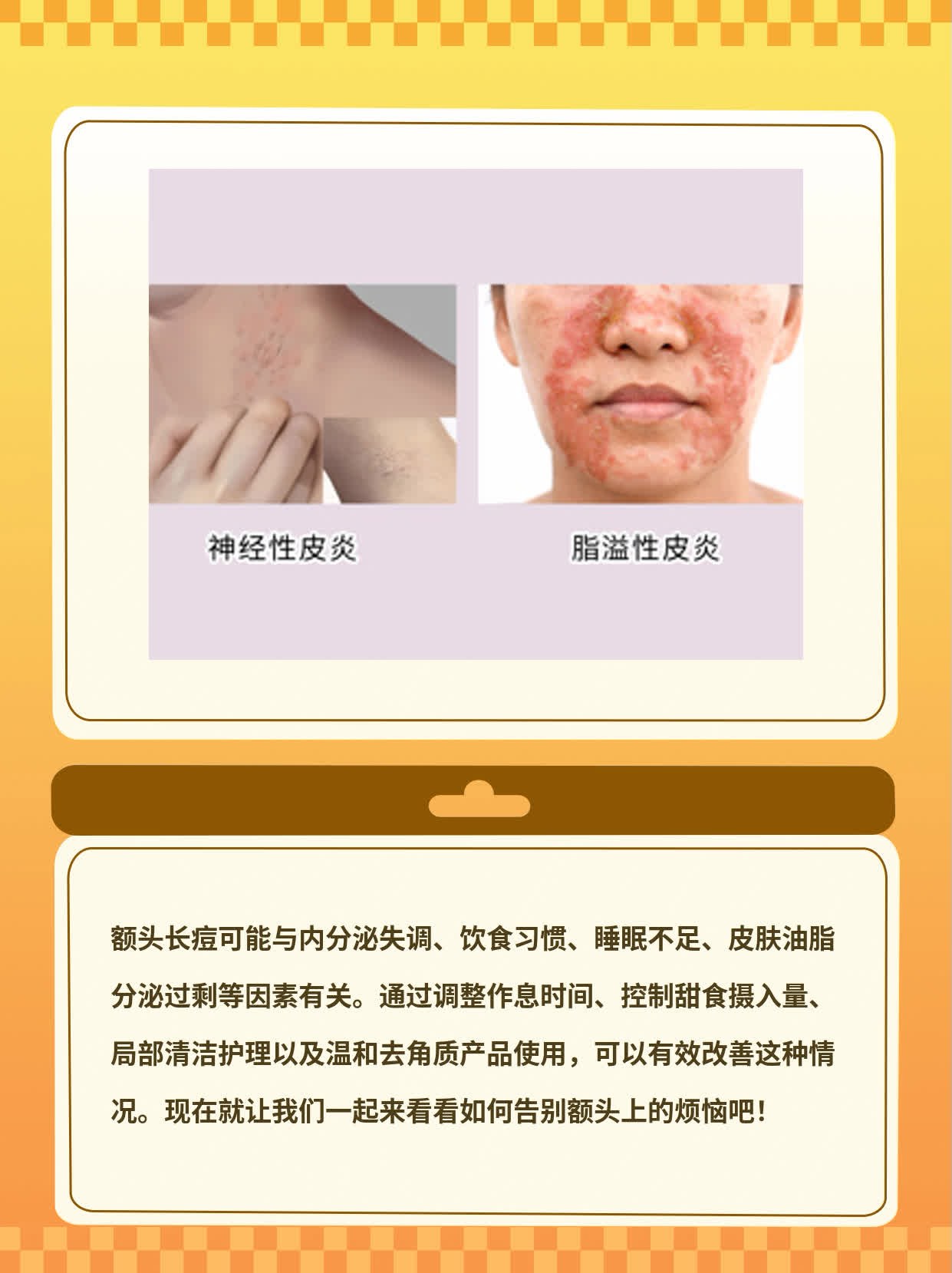「额头长痘」：揪出元凶，告别烦恼！