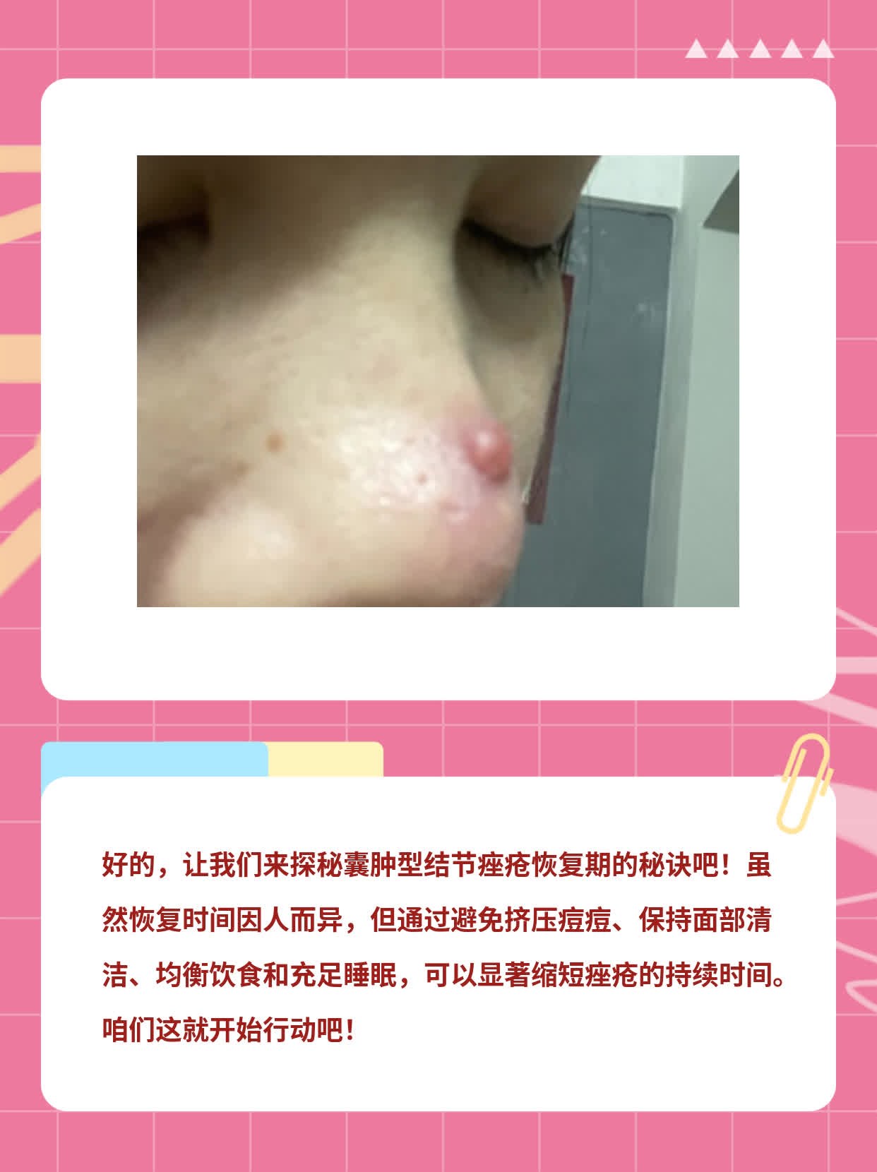 囊肿型结节痤疮恢复期探秘