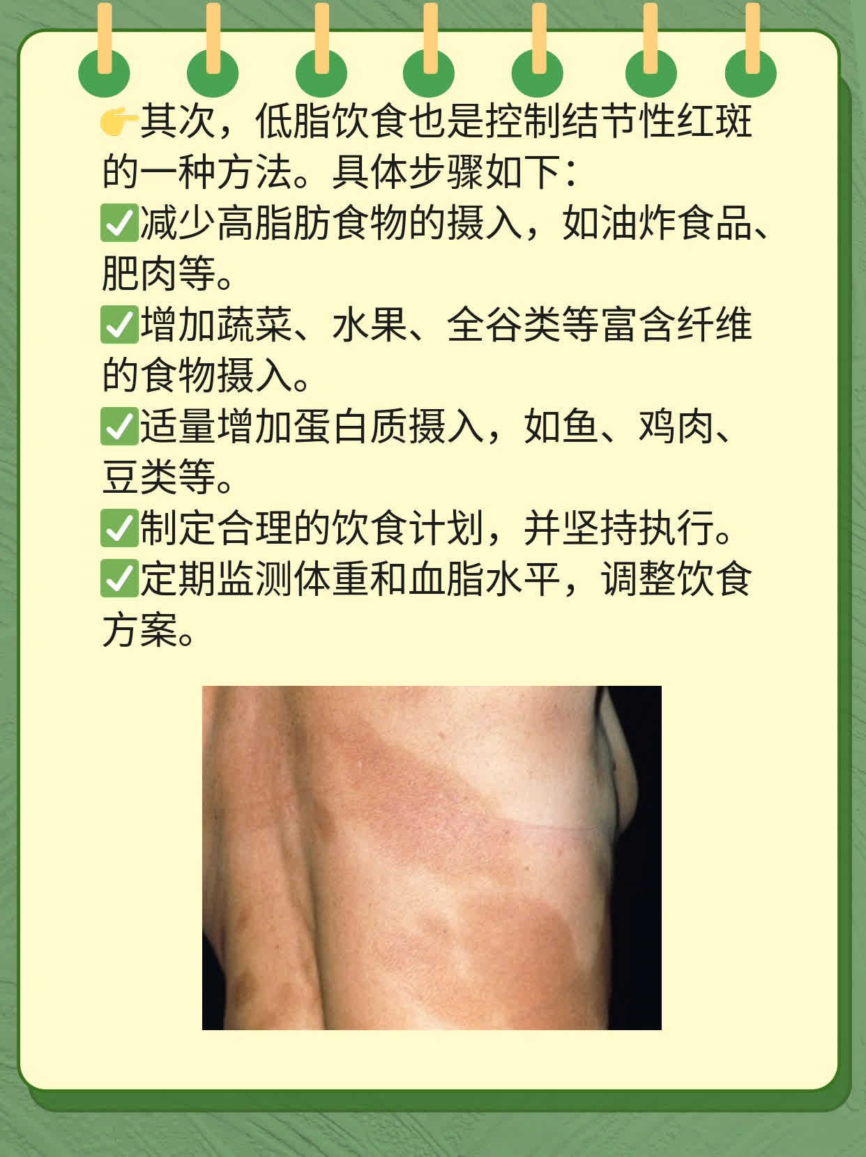 「结节性红斑」临床表现全揭秘！