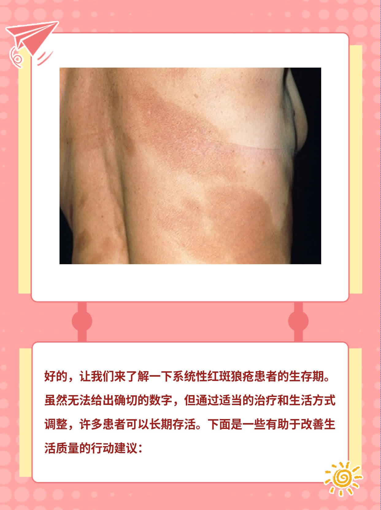 「系统性红斑狼疮」能活多久？这里有答案！