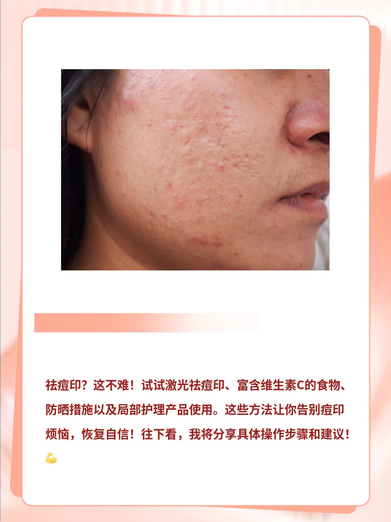 「祛痘印」超快方法！用啥能搞定？